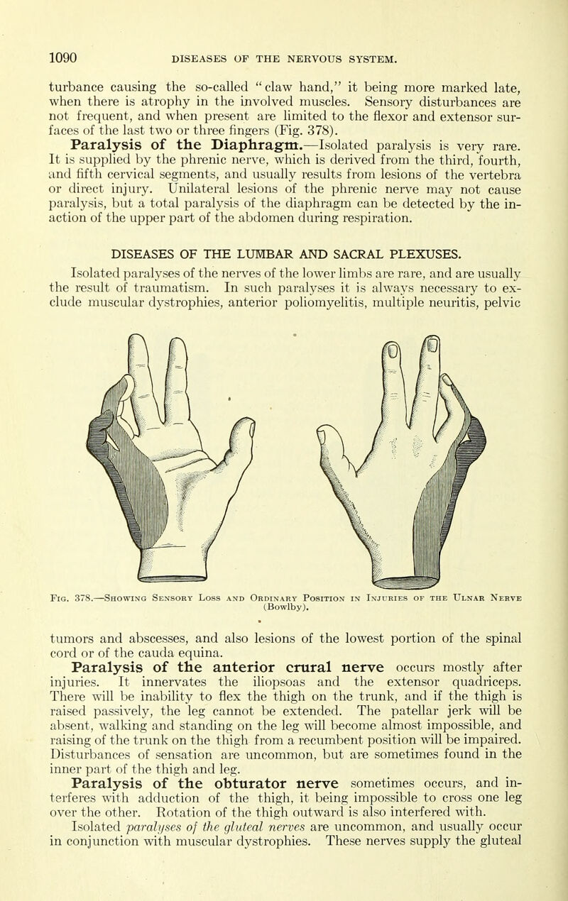 turbance causing the so-called claw hand, it being more marked late, when there is atrophy in the involved muscles. Sensory disturbances are not frequent, and when present are limited to the flexor and extensor sur- faces of the last two or three fingers (Fig. 378). Paralysis of the Diaphragm.—Isolated paralysis is very rare. It is supplied by the phrenic nerve, which is derived from the third, fourth, and fifth cervical segments, and usually results from lesions of the vertebra or direct injury. Unilateral lesions of the phrenic nerve may not cause paralysis, but a total paralysis of the diaphragm can be detected by the in- action of the upper part of the abdomen during respiration. DISEASES OF THE LUMBAR AND SACRAL PLEXUSES. Isolated paralyses of the nerves of the lower limbs ai-e rare, and are usually the result of traumatism. In such paralyses it is always necessary to ex- clude muscular dystrophies, anterior poliomyelitis, multiple neuritis, pelvic Fig. 378.—Showing Sensorv Loss and Ordinary Position in Injuries of the Ulnar Nerve (Bowlby). tumors and abscesses, and also lesions of the lowest portion of the spinal cord or of the cauda equina. Paralysis of the anterior crural nerve occurs mostly after injuries. It innervates the iliopsoas and the extensor quadriceps. There will be inability to flex the thigh on the trunk, and if the thigh is raised passively, the leg cannot be extended. The patellar jerk will be absent, walking and standing on the leg will become almost impossible, and raising of the trunk on the thigh from a recumbent position will be impaired. Disturbances of sensation are uncommon, but are sometimes found in the inner part of the thigh and leg. Paralysis of the obturator nerve sometimes occurs, and in- terferes with adduction of the thigh, it being impossible to cross one leg over the other. Rotation of the thigh outward is also interfered with. Isolated paralyses of the gluteal nerves are uncommon, and usually occur in conjunction with muscular dystrophies. These nerves supply the gluteal