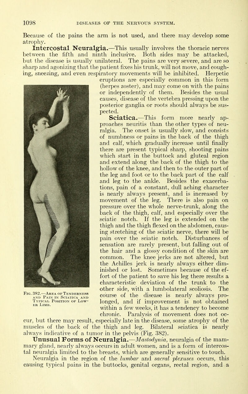 Because of the pains the arm is not used, and there may develop some atrophy. Intercostal Neuralgia.—This usually involves the thoracic nerves between the fifth antl ninth inclusive. Both sides may be attacked, but the disease is usually unilateral. The pains are very severe, and are so sharp and agonizing that the patient fixes his trunk, will not move, and cough- ing, sneezing, and even respiratory movements will be inhibited. Herpetic eruptions are especially common in this form (herpes zoster), and may come on with the pains or independently of them. Besides the usual causes, disease of the vertebra pressing upon the posterior ganglia or roots should always be sus- pected. Sciatica.—This form more nearly ap- proaches neuritis than the other types of neu- ralgia. The onset is usually slow, and consists of numbness or pains in the back of the thigh and calf, which gradually increase until finally there are present typical sharp, shooting pains which start in the buttock and gluteal region and extend along the back of the thigh to the hollow of the knee, and then to the outer part of the leg and foot or to the back part of the calf and leg to the ankle. Besides the exacerba- tions, pain of a constant, dull aching character is nearly always present, and is increased by movement of the leg. There is also pain on pressure over the whole nerve-trunk, along the back of the thigh, calf, and especially over the sciatic notch. If the leg is extended on the thigh and the thigh flexed on the abdomen, caus- ing stretching of the sciatic nerve, there will be pain over the sciatic notch. Disturbances of sensation are rarely present, but falling out of the hair and a glossy condition of the skin are common. The knee jerks are not altered, but the Achilles jerk is nearly always either dim- inished or lost. Sometimes because of the ef- fort of the patient to save his leg there results a characteristic deviation of the trunk to the other side, with a lumbolateral scoliosis. The course of the disease is nearly always pro- longed, and if improvement is not obtained within a few weeks, it has a tendency to become chronic. Paralysis of movement does not oc- cur, but there may result, especially late in the disease, some atrophy of the muscles of the back of the thigh and leg. Bilateral sciatica is nearly always indicative of a tumor in the pelvis (Fig. 382). Unusual Forms of Neuralgia.—Mastodynia, neuralgia of the mam- mary gland, nearly always occurs in adult women, and is a form of intercos- tal neuralgia limited to the breasts, which are generally sensitive to touch. Neuralgia in the region of the lumbar and sacral plexuses occurs, this causing typical pains in the buttocks, genital organs, rectal region, and a Fig. 382.—Area of Tenderness AND Pain in Sciatica and Typical Position of Low- er Limb.