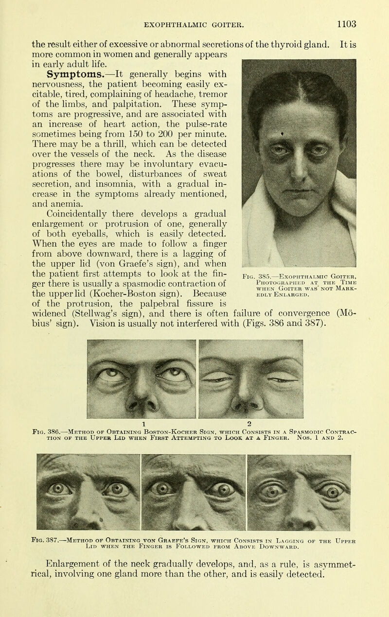 the result either of excessive or abnormal secretions of the thyroid gland. It is more common in women and generally appears in early adult life. Symptoms.—It generally begins with nervousness, the patient becoming easily ex- citable, tired, complaining of headache, tremor of the limbs, and palpitation. These symp- toms are progressive, and are associated with an increase of heart action, the pulse-rate sometimes being from 150 to 200 per minute. There may be a thrill, which can be detected over the vessels of the neck. As the disease progresses there may be involuntary evacu- ations of the bowel, disturbances of sweat secretion, and insomnia, with a gradual in- crease in the symptoms already mentioned, and anemia. Coincidentally there develops a gradual enlargement or protrusion of one, generally of both eyeballs, which is easily detected. When the eyes are made to follow a finger from above downward, there is a lagging of the upper lid (von Graefe's sign), and when the patient first attempts to look at the fin- ger there is usually a spasmodic contraction of the upper lid (Kocher-Boston sign). Because of the protrusion, the palpebral fissure is widened (Stellwag's sign), and there is often failure of convergence (Mo bins' sign). Vision is usually not interfered with (Figs. 386 and 387). Fig. 385 Exophthalmic Goiter, Photographed at the Time WHEN Goiter was' not Mark- edly Enlarged. 1 2 Fig. 386.—Method of Obtaining Boston-Kocher Sign, which Consists in a Spasmodic Contrac- tion OF THE Upper Lid when First Attempting to Look at a Finger. Nos. 1 and 2. Fig. 387.—Method of Obtaining von Graefe's Sign, which Consists in Lagging of the Upper Lid when the Finger is Followed from Above Downward. Enlargement of the neck gradually develops, and, as a rule, is asymmet- rical, involving one gland more than the other, and is easily detected.