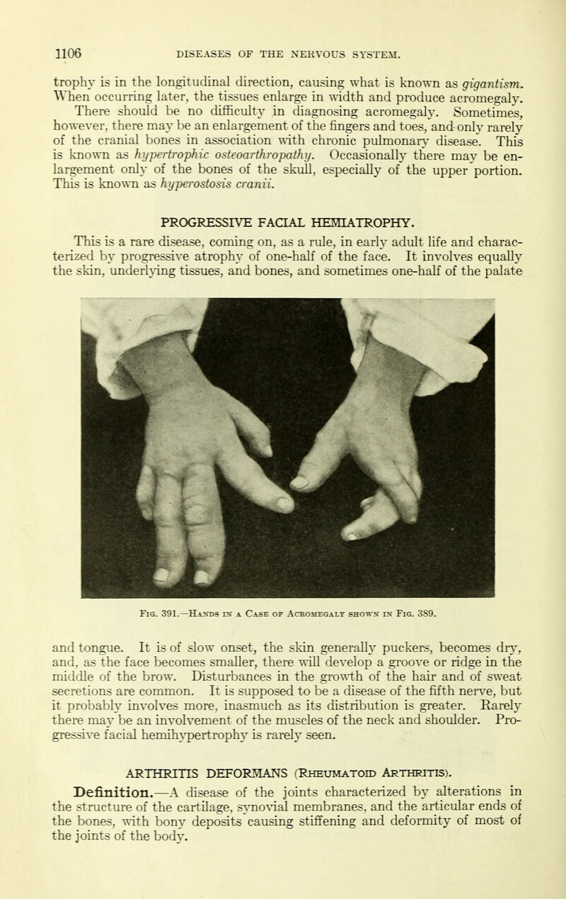 trophy is in the longitudinal direction, causing what is known as gigantism. When occurring later, the tissues enlarge in \\Tdth and produce acromegaly. There should be no difficulty in diagnosing acromegaly. Sometimes, however, there may be an enlargement of the fingers and toes, and onlv rarely of the cranial bones in association -n-ith chronic pulmonaiy disease. This is known as hypertrophic osteoarthropathy. Occasionally there may be en- largement only of the bones of the skull, especially of the upper portion. This is known as hypei-ostosi^ cranii. PROGRESSIVE FAOAL HEHIATROPHY. This is a rare disease, coming on, as a rule, in early adult life and charac- terized by progressive atrophy of one-half of the face. It involves equally the skin, underh-ing tissues, and bones, and sometimes one-half of the palate Fig. 391.—H-Otds ix a Case of Aceomegalt sho^tu in Fig. 389. and tongue. It is of slow onset, the skin generally puckers, becomes dn,-, and, as the face becomes smaller, there vn]l develop a groove or ridge in the middle of the brow. Disturbances in the growth of the hair and of sweat secretions are common. It is supposed to be a di.sease of the fifth ner^'e, but it probably involves more, inasmuch as its distribution is greater. Rarely there may be an involvement of the muscles of the neck and shoulder. Pro- gressive facial hemihypertrophy is rarely seen, ARTHRITIS DEFORMANS (Rheumatoid Arthritis). Definition.—A disease of the joints characterized by alterations in the structure of the cartilage, s}Tio\'ial membranes, and the articular ends of the bones, with bony deposits causing stiffening and deformity of most of the joints of the body.