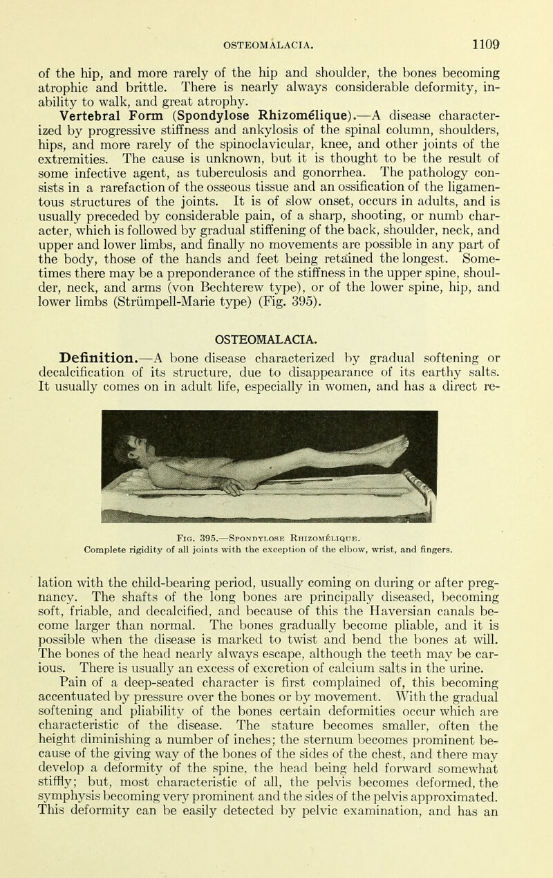 of the hip, and more rarely of the hip and shoulder, the bones becoming atrophic and brittle. There is nearly always considerable deformity, in- ability to walk, and great atrophy. Vertebral Form (Spondylose Rhizomelique).—A disease character- ized by progressive stiffness and ankylosis of the spinal column, shoulders, hips, and more rarely of the spinoclavicular, knee, and other joints of the extremities. The cause is unknown, but it is thought to be the result of some infective agent, as tuberculosis and gonorrhea. The pathology con- sists in a rarefaction of the osseous tissue and an ossification of the ligamen- tous structures of the joints. It is of slow onset, occurs in adults, and is usually preceded by considerable pain, of a sharp, shooting, or numb char- acter, which is followed by gradual stiffening of the back, shoulder, neck, and upper and lower limbs, and finally no movements are possible in any part of the body, those of the hands and feet being retained the longest. Some- times there may be a preponderance of the stiffness in the upper spine, shoul- der, neck, and arms (von Bechterew type), or of the lower spine, hip, and lower limbs (Striimpell-Marie type) (Fig. 395). OSTEOMALACIA. Definition.—A bone disease characterized by gradual softening or decalcification of its structure, due to disappearance of its earthy salts. It usually comes on in adult life, especially in women, and has a direct re- FiG. 395.—Spondylose Rhizomelique. Complete rigidity of all joints with the exception of the elbow, wrist, and fingers. lation with the child-bearing period, usually coming on during or after preg- nancy. The shafts of the long bones are principally diseased, becoming soft, friable, and decalcified, and because of this the Haversian canals be- come larger than normal. The bones gradually become pliable, and it is possible when the disease is marked to twist and bend the l^ones at will. The bones of the head nearly always escape, although the teeth may be car- ious. There is usually an excess of excretion of calcium salts in the urine. Pain of a deep-seated character is first complained of, this becoming accentuated by pressure over the bones or by movement. With the gradual softening and pliability of the bones certain deformities occur which are characteristic of the disease. The stature becomes smaller, often the height diminishing a number of inches; the sternum becomes prominent be- cause of the giving way of the bones of the sides of the chest, and there may develop a deformity of the spine, the head being held forward somewhat stiffly; but, most characteristic of all, the pelvis becomes deformed, the symphysis becoming very prominent and the sides of the pelvis approximated. This deformity can be easily detected by pelvic examination, and has an