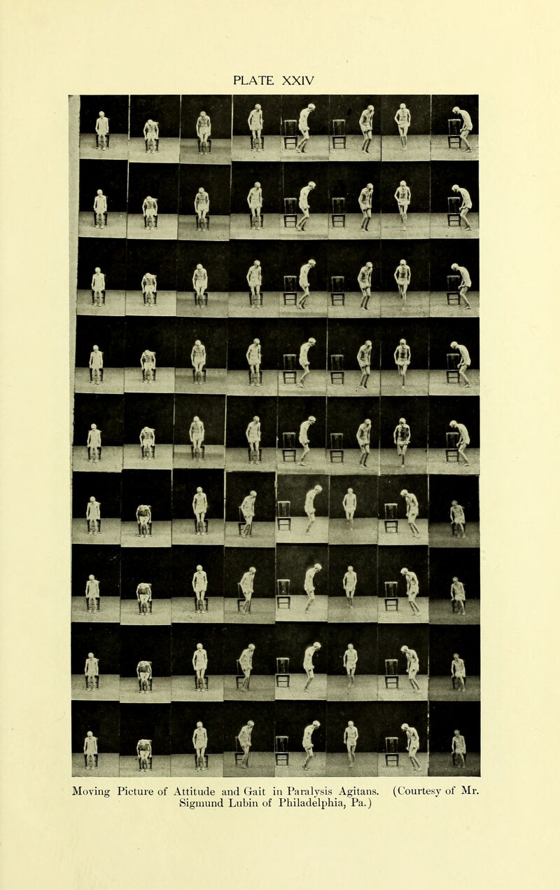 Moving Picture of Attitude and (ruit in Paralysis Agitans. (Courtesy of Mr. Sigmund Lubin of Philadelphia, Pa.)