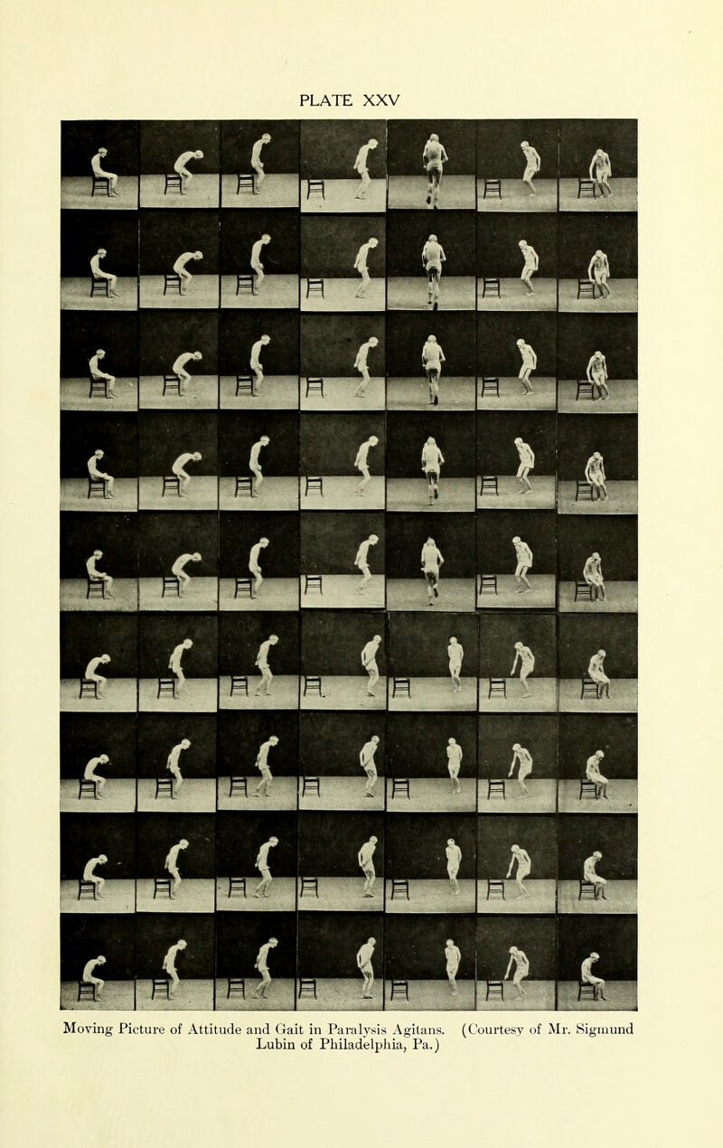 Moving Picture of Attitude and (iait in Paralysis Agilans. (Courtesy of Mr. Sigiuund Lubin of Pliiladelpliia, Pa.)