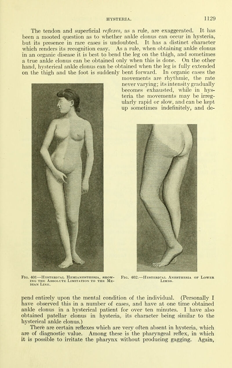 The tendon and superficial reflexes, as a rule, are exaggerated. It has been a mooted question as to whether ankle clonus can occur in hysteria, but its presence in rare cases is undoubted. It has a distinct character which renders its recognition easy. As a rule, when obtaining ankle clonus in an organic disease it is best to bend the leg on the thigh, and sometimes a true ankle clonus can be obtained only when this is done. On the other hand, hysterical ankle clonus can be obtained when the leg is fully extended on the thigh and the foot is suddenly bent forward. In organic cases the movements are rhythmic, the rate never varying; its intensity gradually becomes exhausted, while in hys- teria the movements may be irreg- ularly rapid or slow, and can be kept up sometimes indefinitely, and de- FiG. 401—HystericaI/ Hemianesthesia, show- ing THE Absolute Limitation to the Me- dian Line. Fig. 402.- -Htsterical Anesthesia op Lower Limbs. pend entirely upon the mental condition of the individual. (Personally I have observed this in a number of cases, and have at one time obtained ankle clonus in a hysterical patient for over ten minutes. I have also obtained patellar clonus in hysteria, its character being similar to the hysterical ankle clonus.) There are certain reflexes which are very often absent in hysteria, which are of diagnostic value. Among these is the pharyngeal reflex, in which it is possible to irritate the pharynx without producing gagging. Again,