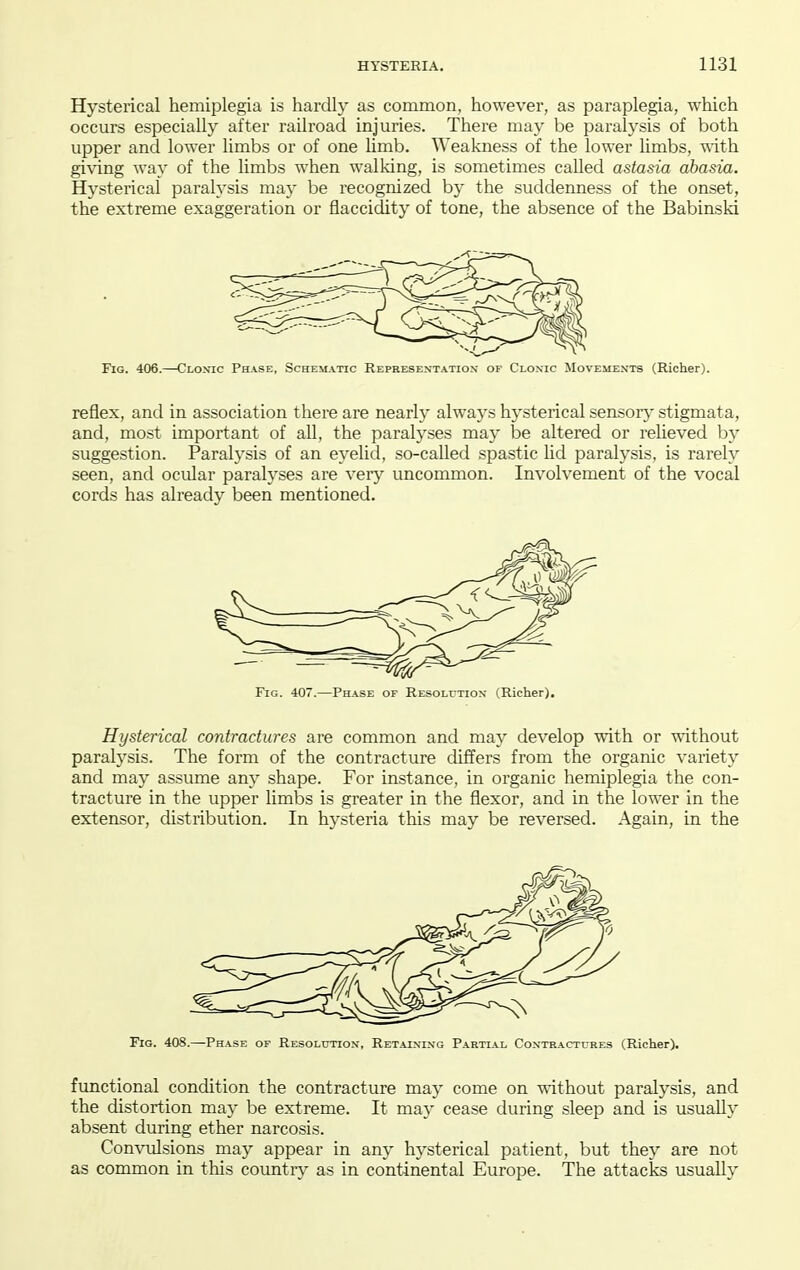 Hysterical hemiplegia is hardl}^ as common, however, as paraplegia, which occurs especially after railroad injuries. There may be paralysis of both upper and lower limbs or of one Umb. Weakness of the lower limbs, with giving way of the limbs when walking, is sometimes called astasia abasia. Hysterical paralysis may be recognized by the suddenness of the onset, the extreme exaggeration or flaccidity of tone, the absence of the Babinski Fig. 406.—Cloxic Phase, Schematic Representation' of Clonic Movements (Richer). reflex, and in association there are nearly always hy.sterical sensorj'stigmata, and, most important of all, the paralyses may be altered or relieved by suggestion. Paralysis of an eyelid, so-called spastic lid paralysis, is rarely seen, and ocular paralyses are very uncommon. Involvement of the vocal cords has already been mentioned. Fig. 407.—Phase of Resolution (Richer). Hysterical contractures are common and may develop with or without paralysis. The form of the contracture differs from the organic variety and may assume any shape. For instance, in organic hemiplegia the con- tracture in the upper limbs is greater in the flexor, and in the lower in the extensor, distribution. In hysteria this may be reversed. Again, in the Fig. 408.—Phase of REsoLtmoN, Retaining Partial Contractures (Richer). functional condition the contracture may come on -without paralysis, and the distortion may be extreme. It may cease during sleep and is usually absent during ether narcosis. Convulsions may appear in any hysterical patient, but thej^ are not as common in this countiy as in continental Europe. The attacks usually
