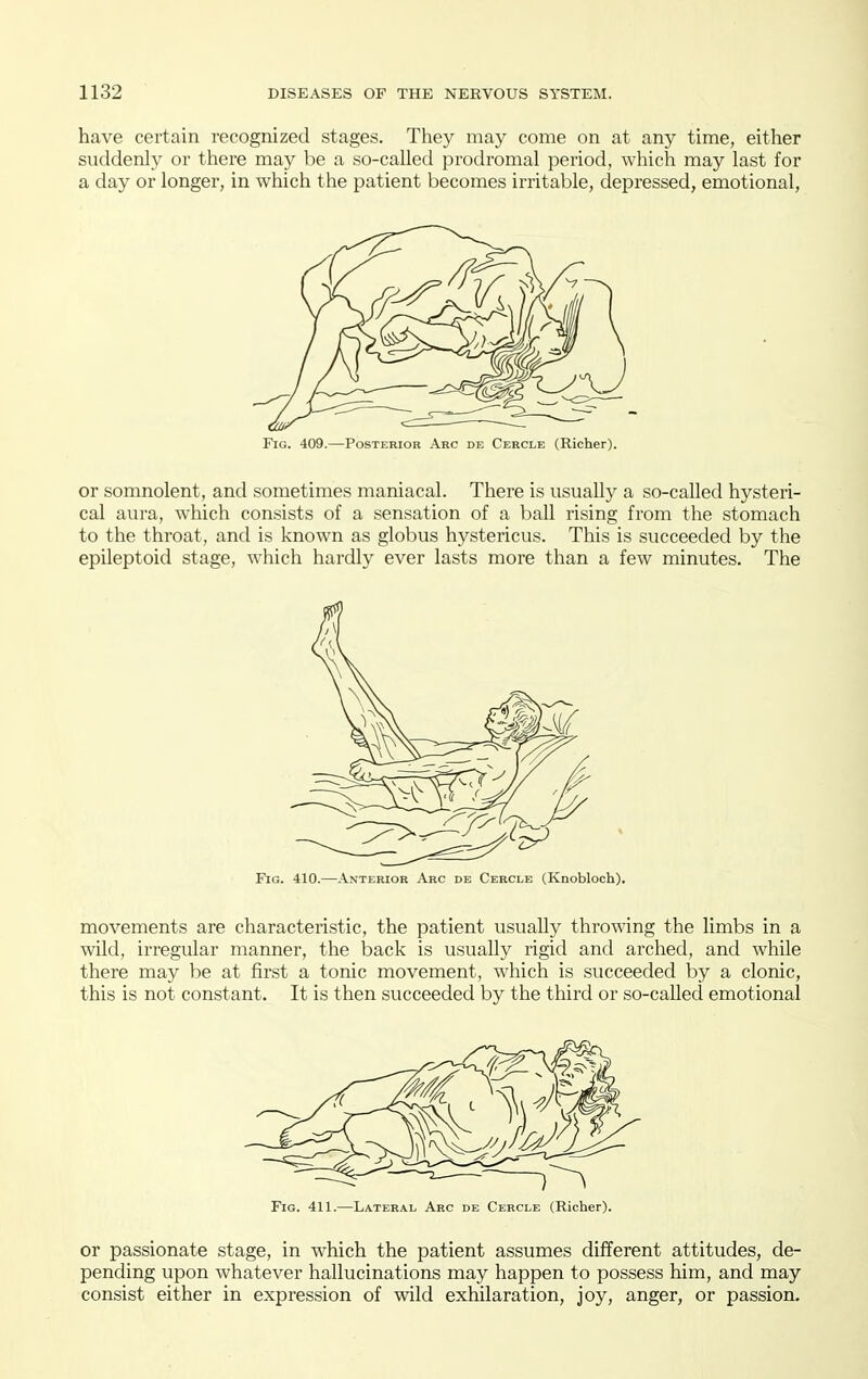 have certain recognized stages. They may come on at any time, either suddenly or there may be a so-called prodromal period, which may last for a day or longer, in which the patient becomes irritable, depressed, emotional. Fig. 409.—Posterior Arc de Cercle (Richer). or somnolent, and sometimes maniacal. There is usually a so-called hysteri- cal aura, which consists of a sensation of a ball rising from the stomach to the throat, and is known as globus hystericus. This is succeeded by the epileptoid stage, which hardly ever lasts more than a few minutes. The Fig. 410.—Anterior Arc de Cercle (Knobloch). movements are characteristic, the patient usually throwing the limbs in a wild, irregular manner, the back is usually rigid and arched, and while there may be at first a tonic movement, which is succeeded by a clonic, this is not constant. It is then succeeded by the third or so-called emotional Fig. 411.—Lateral Arc de Cercle (Richer). or passionate stage, in which the patient assumes different attitudes, de- pending upon whatever hallucinations may happen to possess him, and may consist either in expression of wild exhilaration, joy, anger, or passion.