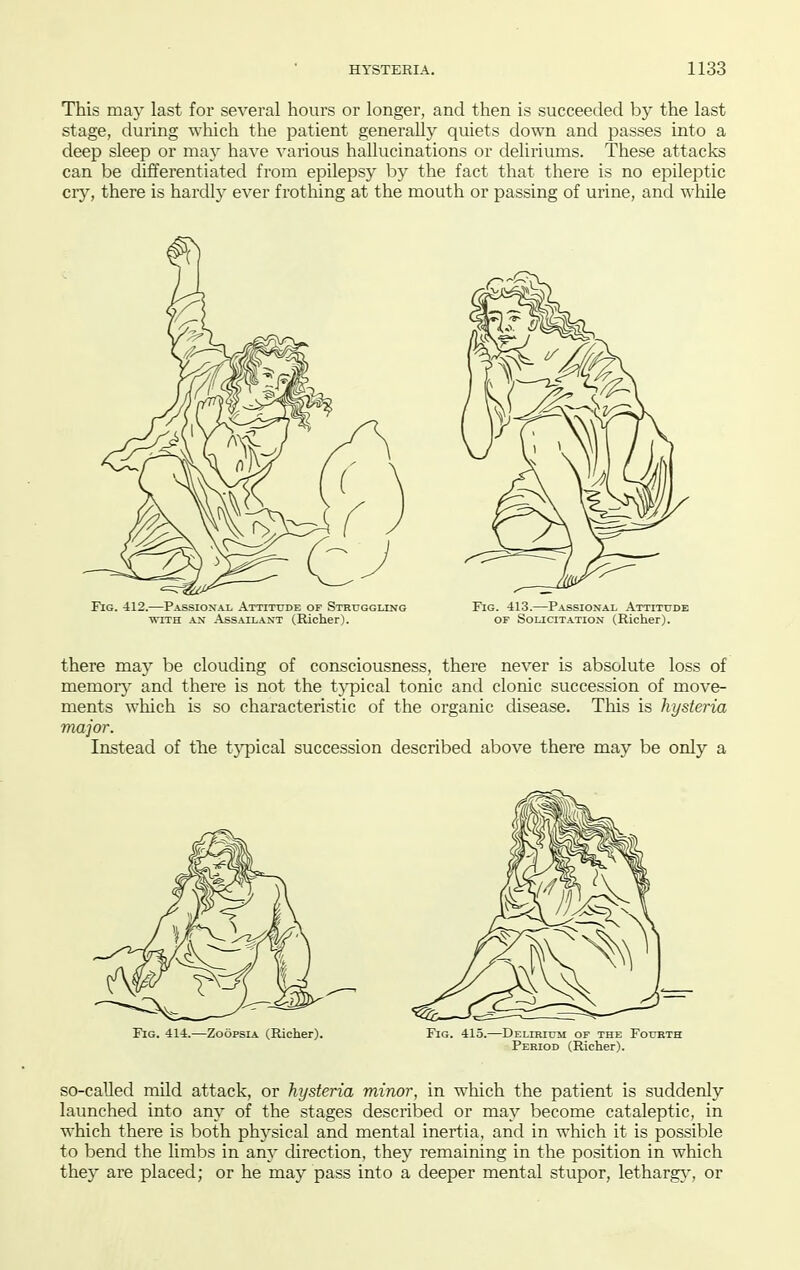 This may last for several hours or longer, and then is succeeded by the last stage, during which the patient generally quiets down and passes into a deep sleep or ma}' have various hallucinations or deliriums. These attacks can be differentiated from epilepsy by the fact that there is no epileptic cry, there is hardly ever frothing at the mouth or passing of urine, and while Fig. 412.—Passional Attitude of Struggling Fig. -113.—Passional .\ttitude WITH an Assailant (Richer). of Solicitation (Richer). there may be clouding of consciousness, there never is absolute loss of memoiy and there is not the t}'pical tonic and clonic succession of move- ments which is so characteristic of the organic disease. This is hysteria major. Instead of tlie t3TDical succession described above there may be only a Fig. 414.—Zoopsia (Richer). Fig. 415.—Delirium of the Fourth Period (Richer). so-called mild attack, or hysteria minor, in which the patient is suddenly launched into any of the stages described or may become cataleptic, in which there is both phj^sical and mental inertia, and in which it is possible to bend the limbs in any direction, they remaining in the position in which they are placed; or he may pass into a deeper mental stupor, letharg}^, or