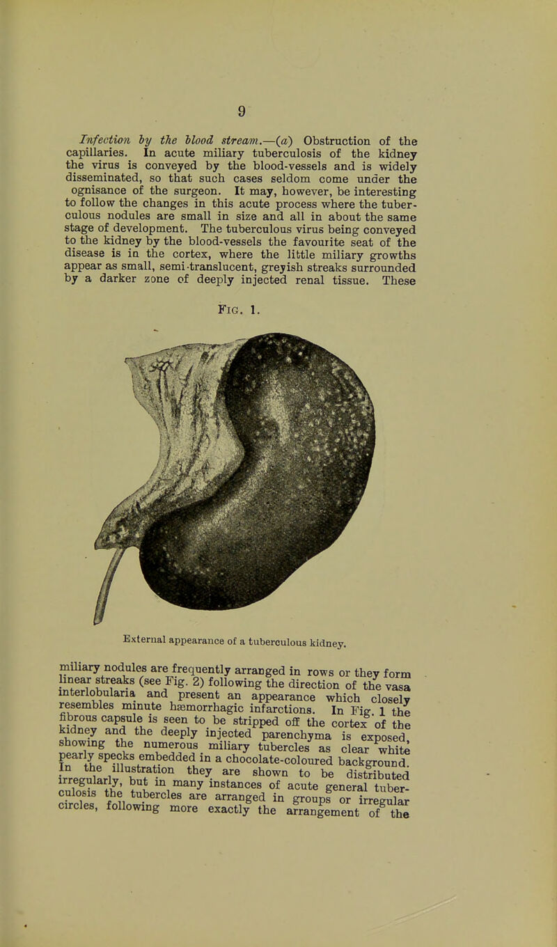 Infection hy tTie blood stream.—(a) Obstruction of the capillaries. In acute miliary tuberculosis of the kidney the virus is conveyed by the blood-vessels and is widely disseminated, so that such cases seldom come under the ognisance of the surgeon. It may, however, be interesting to follow the changes in this acute process where the tuber- culous nodules are small in size and all in about the same stage of development. The tuberculous virus being conveyed to the kidney by the blood-vessels the favourite seat of the disease is in the cortex, where the little miliary growths appear as small, semi-translucent, greyish streaks surrounded by a darker zone of deeply injected renal tissue. These Fig. 1. External appearance of a tuberculous kidney. mihary nodules are frequently arranged in rows or they form linear streaks (see Fig. 2) following the direction of the vasa mterlobularia and present an appearance which closely resembles mmute hemorrhagic infarctions. In Fie 1 the Snpv^if^ fl'^r'^'^^^.^.^ °2 cortex^ of the kidney and the deeply injected parenchyma is exposed showing the numerous miliary tubercles^ as clear white pearly specks embedded in a chocolate-coloured background In the Illustration they are shown to be distributed irregularly, but in many instances of acute genera tuber- culosis the tubercles are arranged in groups or irrpl,il«r circles, following more exactly^ the afran|ement o?^^^^^