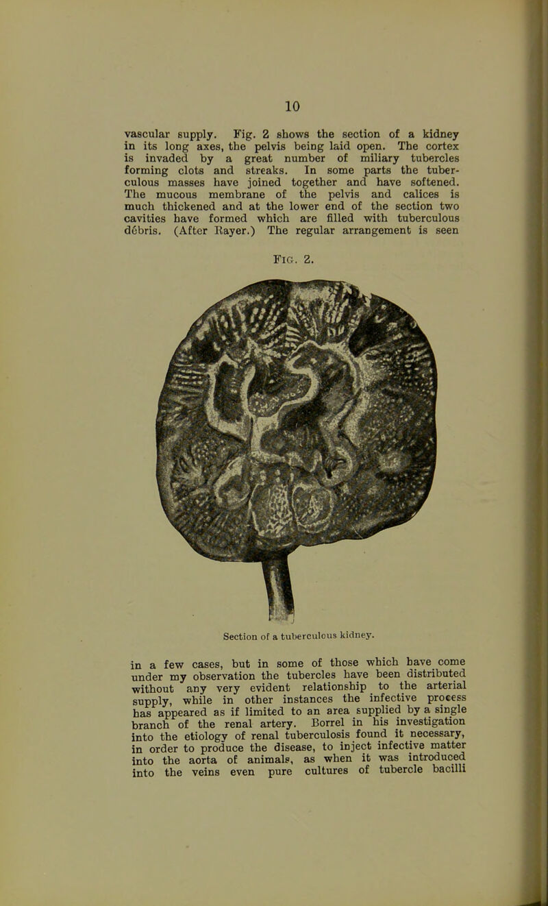 vascular supply. Fig. 2 shows the section of a kidney in its long axes, the pelvis being laid open. The cortex is invaded by a great number of miliary tubercles forming clots and streaks. In some parts the tuber- culous masses have joined together and have softened. The mucous membrane of the pelvis and calices is much thickened and at the lower end of the section two cavities have formed which are filled with tuberculous d6bris. (After Rayer.) The regular arrangement is seen Fig. 2. Section of a tuberculous kidney. in a few cases, but in some of those which have come under my observation the tubercles have been distributed without any very evident relationship to the arterial supply, while in other instances the infective process has appeared as if limited to an area supplied by a single branch of the renal artery. Borrel in his investigation into the etiologv of renal tuberculosis found it necessary, in order to produce the disease, to inject infective matter into the aorta of animals, as when it was introduced into the veins even pure cultures of tubercle bacilli