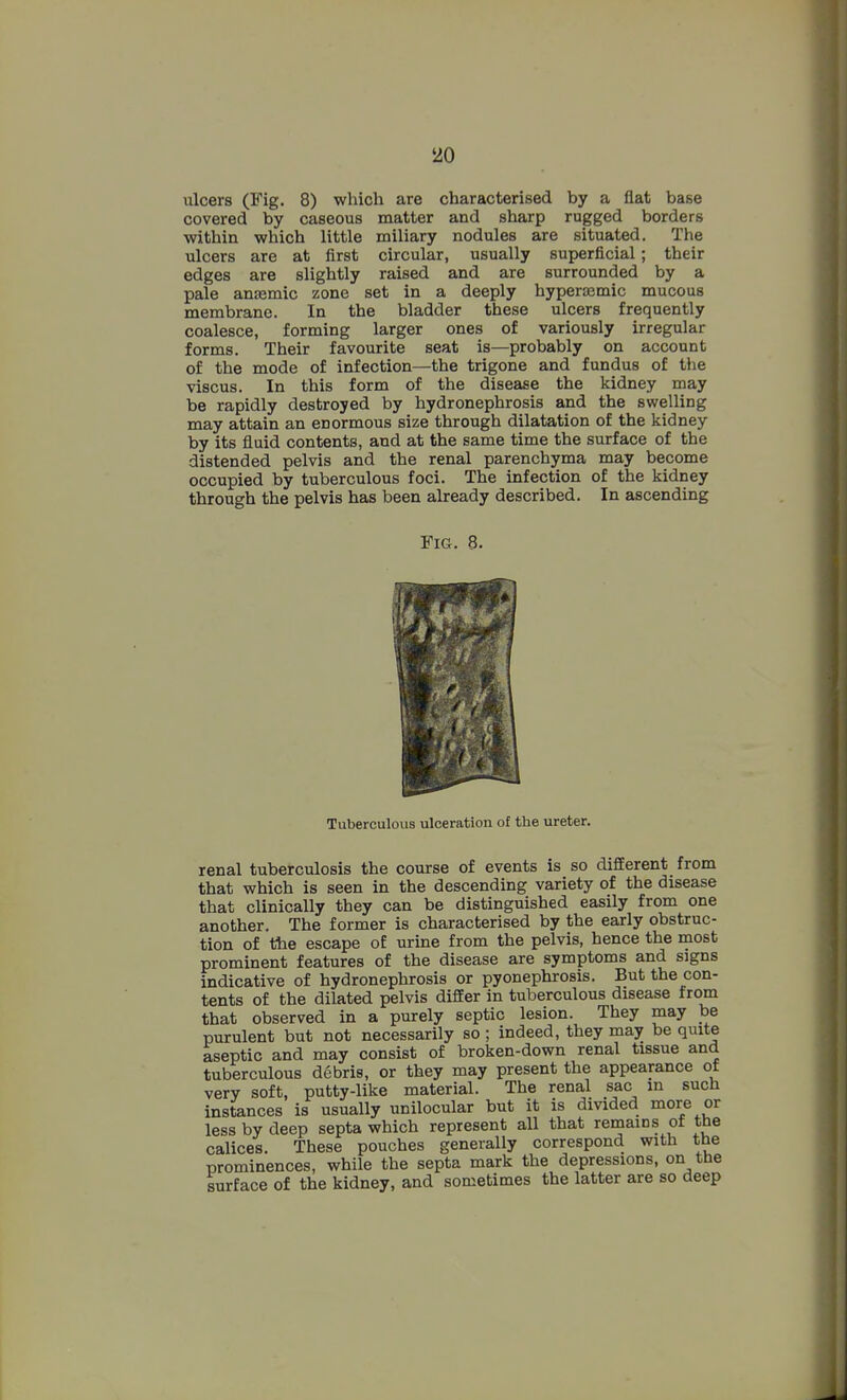 'AO ulcers (Fig. 8) which are characterised by a flat base covered by caseous matter and sharp rugged borders within which little miliary nodules are situated. The ulcers are at first circular, usually superficial; their edges are slightly raised and are surrounded by a pale ansemic zone set in a deeply hyperjemic mucous membrane. In the bladder these ulcers frequently coalesce, forming larger ones of variously irregular forms. Their favourite seat is—probably on account of the mode of infection—the trigone and fundus of the viscus. In this form of the disease the kidney may be rapidly destroyed by hydronephrosis and the swelling may attain an enormous size through dilatation of the kidney by its fluid contents, and at the same time the surface of the distended pelvis and the renal parenchyma may become occupied by tuberculous foci. The infection of the kidney through the pelvis has been already described. In ascending Fig. 8. renal tuberculosis the course of events is so different from that which is seen in the descending variety of the disease that clinically they can be distinguished easily from one another. The former is characterised by the early obstruc- tion of the escape of urine from the pelvis, hence the most prominent features of the disease are symptoms and signs indicative of hydronephrosis or pyonephrosis. But the con- tents of the dilated pelvis differ in tuberculous disease from that observed in a purely septic lesion. They may be purulent but not necessarily so ; indeed, they may be quite aseptic and may consist of broken-down renal tissue and tuberculous debris, or they may present the appearance of very soft, putty-like material. The renal sac in such instances is usually unilocular but it is divided more or less by deep septa which represent all that remains of tbe calices. These pouches generally correspond with the prominences, while the septa mark the depressions, on tbe surface of the kidney, and sometimes the latter are so deep