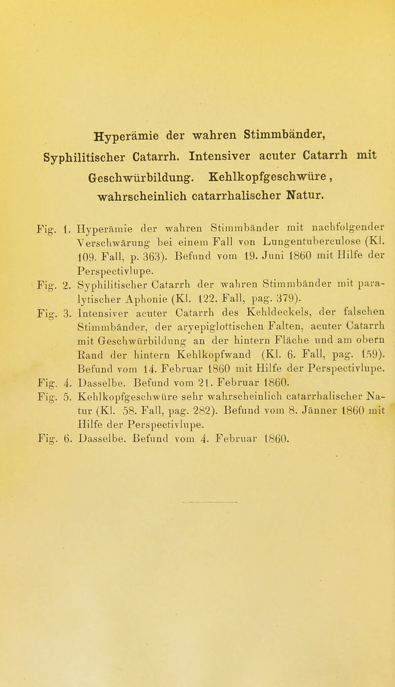 Hyperämie der wahren Stimmbänder, Syphilitischer Catarrh. Intensiver acuter Catarrh mit Geschwürbildung. Kehlkopfgeschwüre, wahrscheinlich catarrhalischer Natur. Fig. 1. Hyperämie der waliren Stimmbänder mit nachfolgender Verscliwärnng bei einem Fall von Lungentuberculose (Kl. 109. Fall, p. 363). Befund vom 19. Juni 1860 mit Hilfe der Perspectivlupe. Fig. 2. Sypliilitisclier Catarrh der wahren Stimmbänder mit para- lytischer Aphonie (Kl. 122. Fall, pag. 379). Fig. 3. Intensiver acnter Catarrh des Kehldeckels, der falschen Stimmbänder, der aryepiglottischen Falten, acuter Catarrh mit Geschwürbildnng an der hintern Fläche und am obern Eand der hintern Kehlkopfwand (Kl. 6. Fall, pag. 159). Beftmd vom 14. Februar 1860 mit Hilfe der Perspectivlupe. Fig. 4. Dasselbe. Befund vom 21. Februar 1860. Fig. 5. Kehlkopfgeschwüre sehr wahrscheinlich catarrhalischer Na- tur (Kl. 58. Fall, pag. 282). Befund vom 8. Jänner 1860 mit Hilfe der Perspectivlupe.