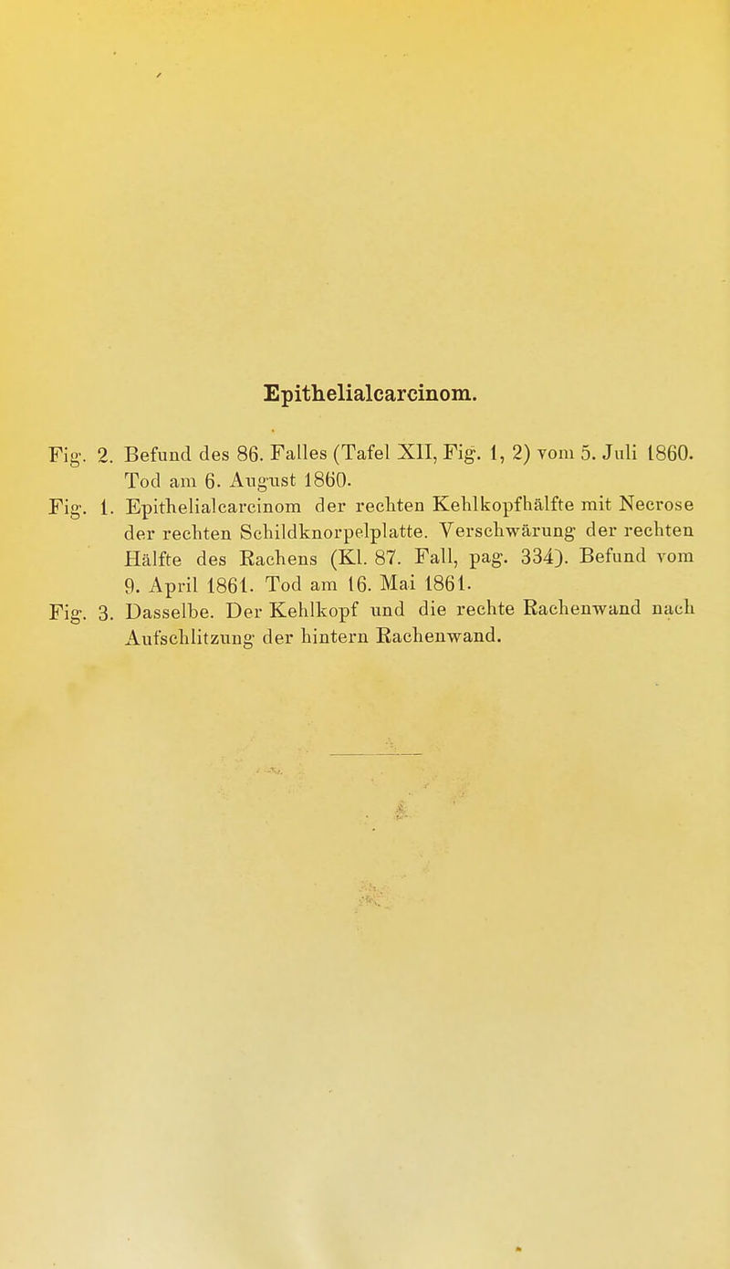 Fig. 2. Befund des 86. Falles (Tafel Xll, Fig. 1, 2) vom 5. Juli 1860. Tod am 6. August 1860. Fig. 1. Epithelialcarcinom der recliten KeWkopfhälfte mit Necrose der rechten Schildknorpelplatte. Verscliwärung der rechten Hälfte des Rachens (Kl. 87. Fall, pag. 334). Befund vom 9. April 1861. Tod am 16. Mai 1861- Fig. 3. Dasselbe. Der Kehlkopf und die rechte ßachenwand nach Aufschlitzung der hintern Rachenwand.