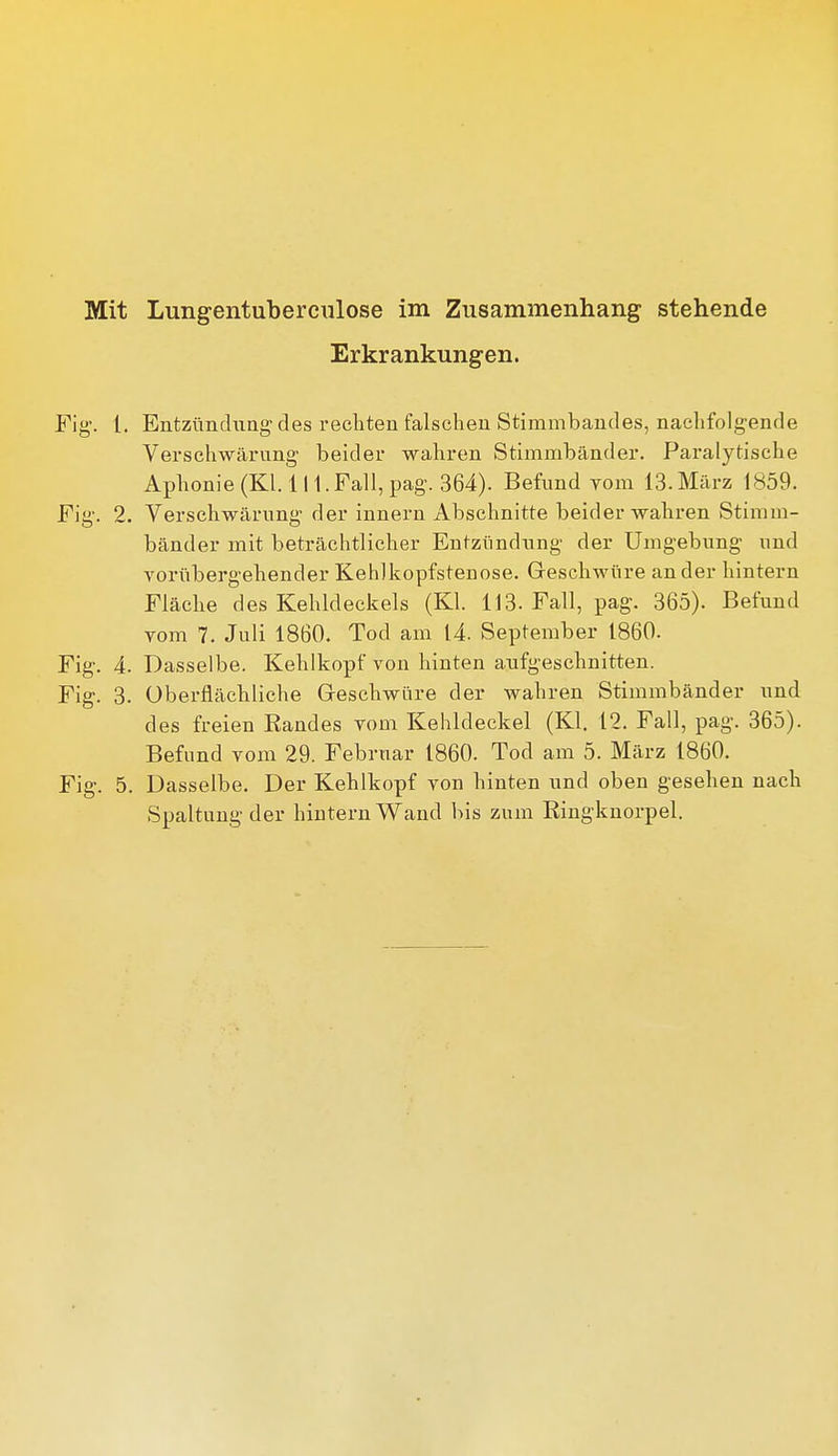 Erkrankungen. Fig-. 1. Entzünchiag des recliten falschen Stimmbaudes, nachfolgende Verschwärung- beider wahren Stimmbänder. Paralytische Aphonie (Kl. 111. Fall, pag. 364). Befund vom 13. März 1859. Fig. 2. Verschwärung der innern Abschnitte beider wahren Stimm- bänder mit beträchtlicher Entzündung der Umgebung und voriibei-gehender Kehlkopfstenose. Greschwüre ander hintern Fläche des Kehldeckels (Kl. 113. Fall, pag. 365). Befund vom 7. Juli 1860. Tod am 14. September 1860. Fig. 4. Dasselbe. Kehlkopf von hinten aufgeschnitten. Fig. 3. Oberflächliche Greschwüre der wahren Stimmbänder und des freien Randes vom Kehldeckel (Kl. 12. Fall, pag. 365). Befund vom 29. Februar 1860. Tod am 5. März 1860. Fig. 5. Dasselbe, Der Kehlkopf von hinten und oben gesehen nach Spaltung der hintern Wand bis zum Eingknorpel.