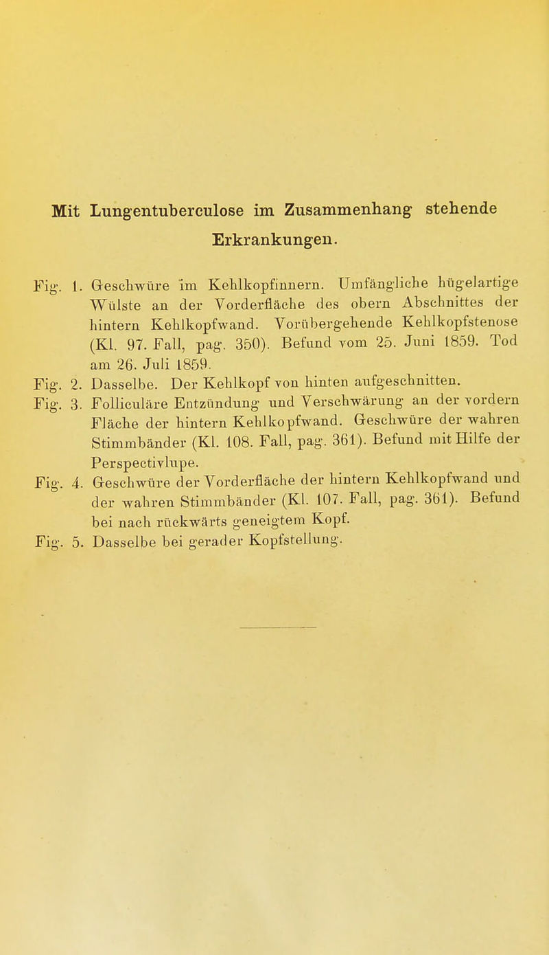 Erkrankungen. Fig. 1. Grescliwüre Im KeUkopfinnern. Umfängliche hiigelartige Wülste an der Vorderfläche des obern Abschnittes der hintern Kehlkopfwand. Vorübergehende Kehlkopfstenose (Kl. 97. Fall, pag. 350). Befund vom 25. Juni 1859. Tod am 26. Jnü 1859. Fig. 2. Dasselbe. Der Kehlkopf von hinten aufgeschnitten. Fig. 3. Follicuhlre Entzündung und Verschwärung an der vordem Fläche der hintern Kehlkopfwand. Geschwüre der wahren Stimmbänder (Kl. 108. Fall, pag. 361). Befund mit Hilfe der Perspectivlnpe. Fig. 4. Geschwüre der Vorderfläche der hintern Kehlkopfwand und der wahren Stimmbänder (Kl. 107. Fall, pag. 361). Befund bei nach rückwärts geneigtem Kopf. Fig. 5. Dasselbe bei gerader Kopfstellung.