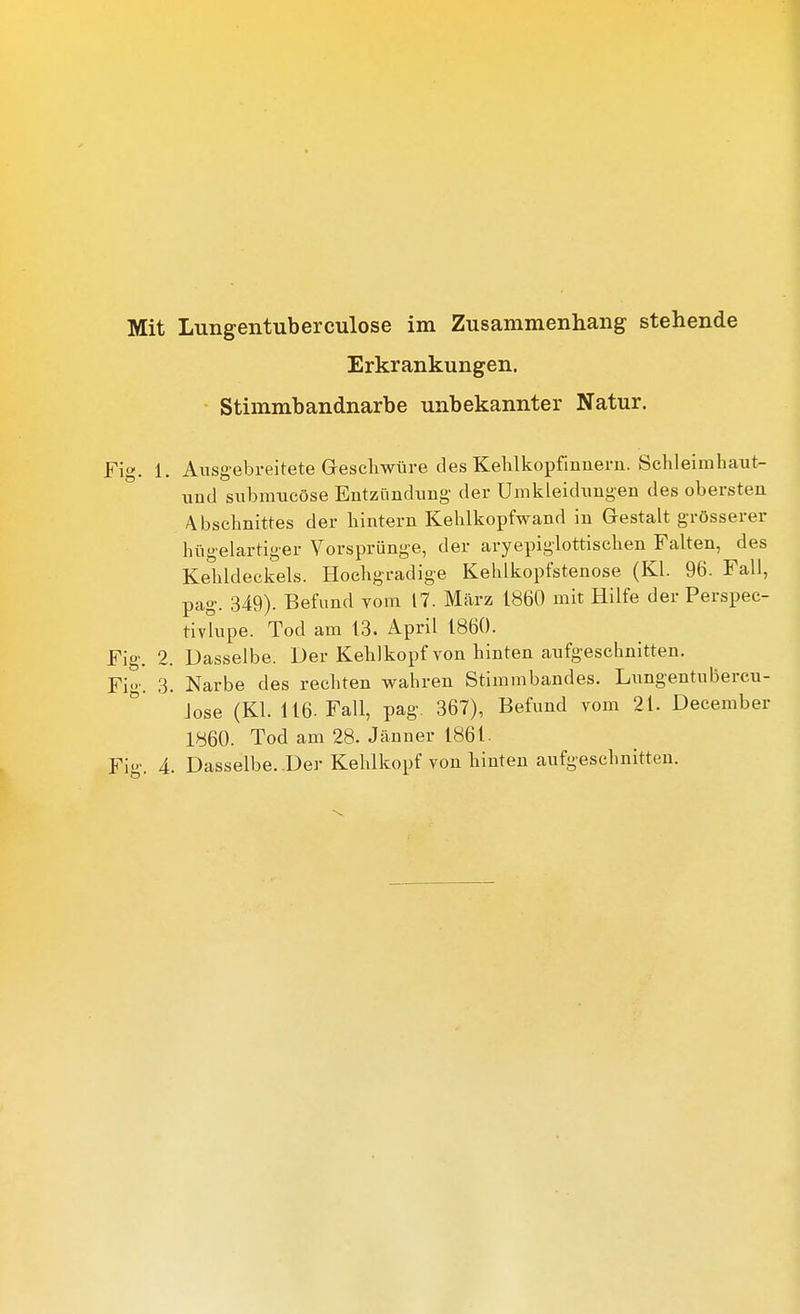 Erkrankungen. Stimmbandnarbe unbekannter Natur. Fig. 1. Ausgebreitete Gescliwüi-e des Kelilkopfmneru. ScKleimhaut- und submucöse EntziindiiBg der Umkleiduugen des obersten Abschnittes der liintern Kehlkopfwand in Gestalt grösserer hiigelartiger Vorsprünge, der aryepiglottischen Falten, des Kehldeckels. Hochgradige Kehlkopfstenose (Kl. 96. Fall, pag. 349). Befund vom 17. März 1860 mit Hilfe der Perspec- tivkipe. Tod am 13. April 1860. Fig. 2. Dasselbe. Der Kehlkopf von hinten aufgeschnitten. Fig. 3. Narbe des rechten wahren Stimmbandes. Lnngentubereu- Jose (Kl. 116. Fall, pag. 367), Befund vom 21. December 1860. Tod am 28. Jäuuer 1861.