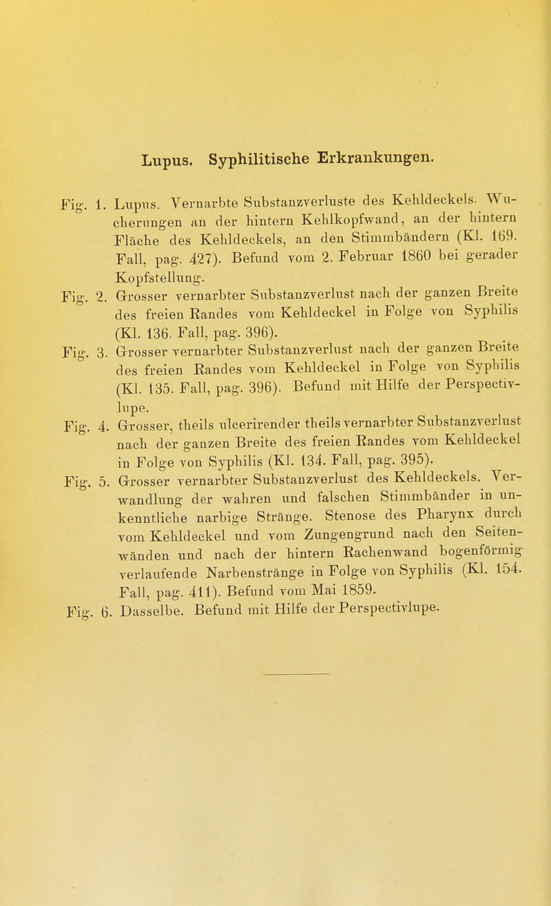 Fig. 1. Lupns. Vernarbte Siibstanzverlnste des Kehldeckels. Wu- clieruDgen an der hintern Kehlkopfwand, an der hintern Fläche des Kehldeckels, an den Stimmbändern (KI. 169. Fall, pag. 427). Befund vom 2. Februar 1860 bei gerader Kopfstellung. Fig. 2. Grosser vernarbter Substanzverlust nach der ganzen Breite des freien Eandes vom Kehldeckel in Folge von Syphilis (Kl. 136. Fall, pag. 396). Fig. 3. Grosser vernarbter Substanzverlust nach der ganzen Breite des freien Bandes vom Kehldeckel in Folge von Syphilis (Kl. 135. Fall, pag. 396). Befund mit Hilfe der Perspectiv- lupe. Fig. 4. Grosser, theils ulcerirender theils vernarbter Substanzverlust nach der ganzen Breite des freien Randes vom Kehldeckel in Folge von Syphilis (Kl. 134. Fall, pag. 395). Fig. 5. Grosser vernarbter Substauzverlust des Kehldeckels. Ver- wandlung der wahren und falschen Stimmbänder in un- kenntliche narbige Stränge. Stenose des Pharynx durch vom Kehldeckel und vom Zungengrund nach den Seiten- wänden und nach der hintern Rachenwand bogenförmig verlaufende Narbenstränge in Folge von Syphilis (Kl. 154. Fall, pag. 411). Befund vom Mai 1859.