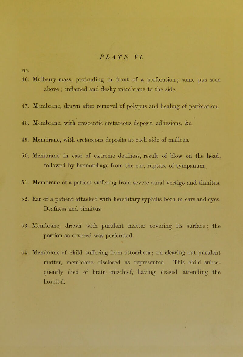 PIG. 46. Mulberry mass, protruding in front of a perforation; some pus seen above ; inflamed and fleshy membrane to the side. 47. Membrane, drawn after removal of polypus and healing of perforation. 48. Membrane, with crescentic cretaceous deposit, adhesions, &c. 49. Membrane, with cretaceous deposits at each side of malleus. 50. Membrane in case of extreme deafness, result of blow on the head, followed by haemorrhage from the ear, rupture of tympanum. 51. Membrane of a patient sufiering from severe aural vertigo and tinnitus. 52. Ear of a patient attacked with hereditary syphilis both in ears and eyes. Deafness and tinnitus. 53. Membrane, drawn with purulent matter covering its surface; the portion so covered was perforated. 54. Membrane of child sufiering from ottorrhoea; on clearing out purulent matter, membrane disclosed as represented. This child subse- quently died of brain mischief, having ceased attending the hospital.