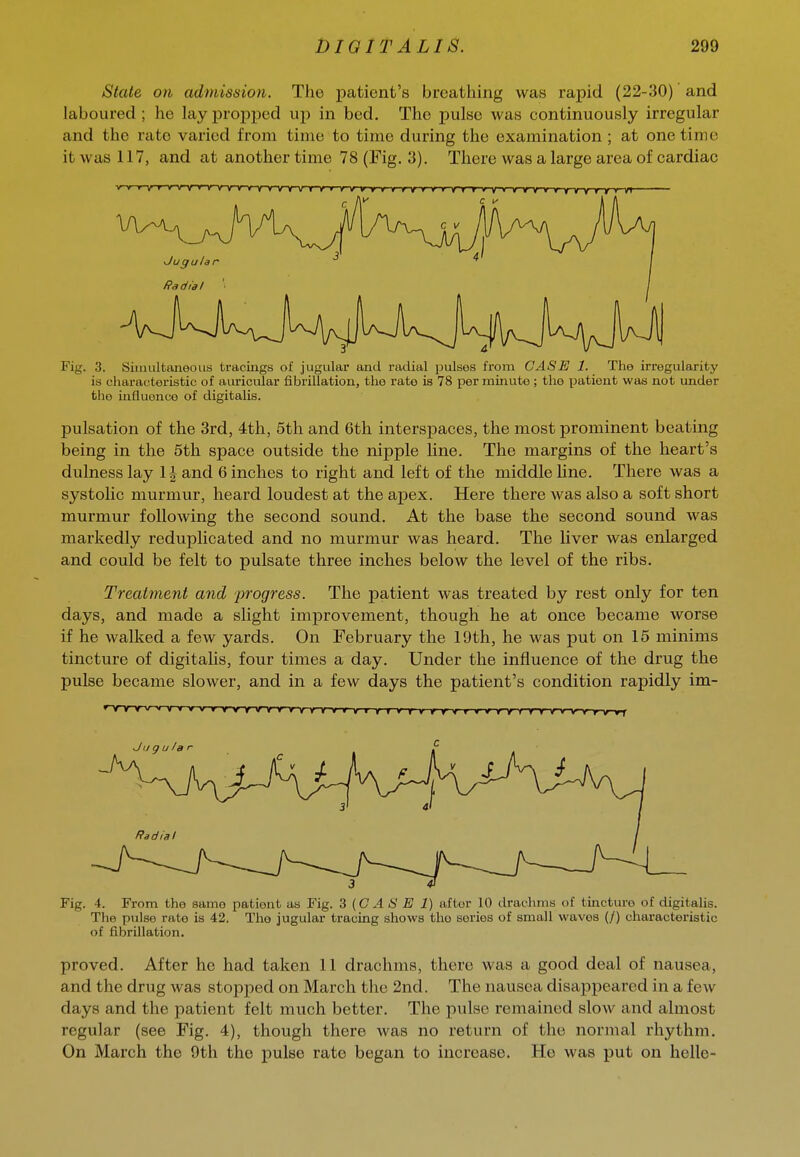 State on admission. The patient's breathing was rapid (22-30) and laboured ; he lay propped uj) in bed. The pulse was continuously irregular and the rate varied from time to time during the examination ; at onetime it was 117, and at another time 78 (Fig. 3). There was a large area of cardiac Fig. 3. Simultaneous tracings of jugular and radial pulses fi'om CASE 1. The irregularity is characteristic of auricular fibrillation, the rate is 78 per minute ; the patient was not under the influence of digitalis. pulsation of the 3rd, 4th, 5th and 6th interspaces, the most prominent beating being in the 5th space outside the nipple line. The margins of the heart's dulnesslay Hand 6 inches to right and left of the middle line. There was a systolic murmur, heard loudest at the apex. Here there was also a soft short murmur following the second sound. At the base the second sound was markedly reduplicated and no murmur was heard. The liver was enlarged and could be felt to pulsate three inches below the level of the ribs. Treatment and progress. The patient was treated by rest only for ten days, and made a slight improvement, though he at once became worse if he walked a few yards. On February the 19th, he was put on 15 minims tincture of digitalis, four times a day. Under the influence of the drug the pulse became slower, and in a few days the patient's condition rapidly im- Fig. 4. From the same patient as Fig. 3 {CASE 1) after 10 drachms of tincture of digitalis. Tlie pulse rate is 42. The jugular tracing shows the series of small waves (/) characteristic of fibrillation. proved. After he had taken 11 drachms, there was a good deal of nausea, and the drug was stopped on March the 2nd. The nausea disappeared in a few days and the patient felt much better. The pulse remained slow and almost regular (see Fig. 4), though there was no return of the normal rhythm. On March the 9th the pulse rate began to increase. He was put on helle-