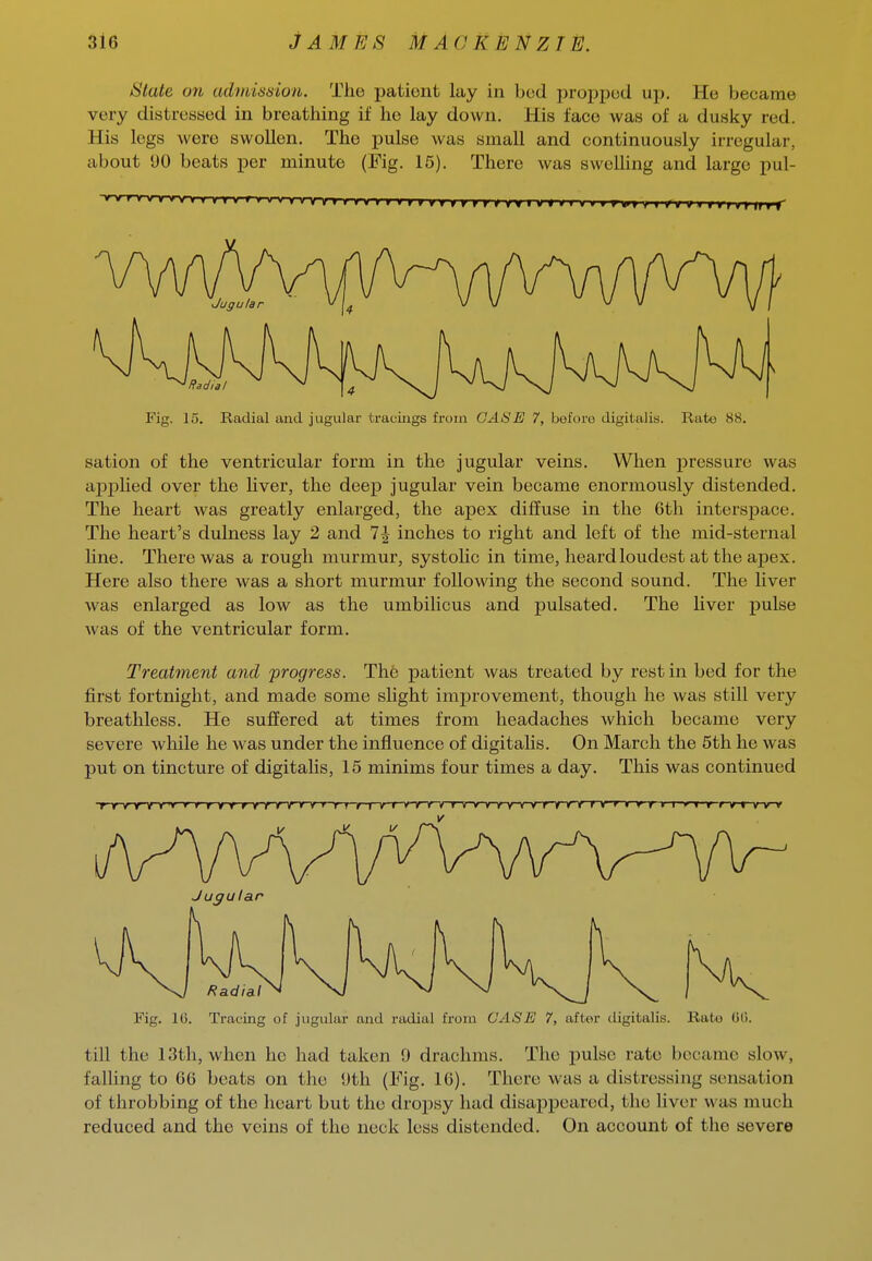 Slate on adndnniun. The pationt lay in bod propped up. He became very distressed in breathing if he lay down. His face was of a dusky red. His legs were swollen. The pulse was small and continuously irregular, about 90 beats per minute (Fig. 15). There was swelling and large pul- Fig. 15. Radial and jugular tracings from CASE 7, before digitalis. Rate 88. sation of the ventricular form in the jugular veins. When pressure was applied over the liver, the deep jugular vein became enormously distended. The heart was greatly enlarged, the apex diffuse in the 6th inters^Dace. The heart's dulness lay 2 and 7| inches to right and left of the mid-sternal line. There was a rough murmur, systolic in time, heard loudest at the apex. Here also there was a short murmur following the second sound. The hver was enlarged as low as the umbilicus and pulsated. The liver pulse was of the ventricular form. Treatment and progress. The patient was treated by rest in bed for the first fortnight, and made some sUght improvement, though he was still very breathless. He suffered at times from headaches which became very severe while he was under the influence of digitaHs. On March the 5th he was put on tincture of digitalis, 15 minims four times a day. This was continued ■yirvyVY'v-r-fr f r r yf •v-yirv r r ; fi / i innrir'rvvTnrYnrvnrnnnf r rr t r r ri y-rrrvt rv-r Fig. 10. Tracing of jugular and radial from CASE 7, after digitalis. Ruto Oli. till the 13th, when ho had taken 9 drachms. The pulse rate became slow, falhng to 66 beats on the 9th (Fig. 16). There was a distressing sensation of throbbing of the heart but the dropsy had disappeared, the liver was much reduced and the veins of the neck less distended. On account of the severe