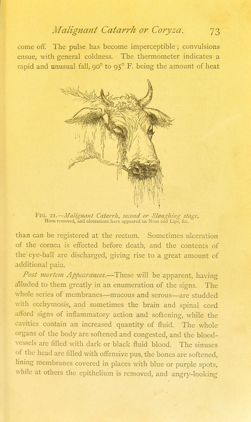 come off. The pulse has become imperceptible; convulsions ensue, with general coldness. The thermometer indicates a rapid and unusual fall, 90° to 95° F. being the amount of heat Fig. 21.—Malig7iant Catarrh, second or SlotiQ;hing stage. Horn removed, and ulcerations have appeared on Nose and Lips, S:c. than can be registered at the rectum. Sometimes ulceration of the cornea is effected before death, and the contents of the eye-ball are discharged, giving rise to a great amount of additional pain. Post mortem Appearances.—These will be apparent, having alluded to them greatly in an enumeration of the signs. The whole series of membranes—mucous and serous—are studded with ccchymosis, and sometimes the brain and spinal cord afford signs of inflammatory action and softening, while the cavities contain an increased quantity of fluid. The whole organs of the body are softened and congested, and the blood- vessels are filled with dark or black fluid blood. The sinuses of the head arc filled with offensive pus, the bones are softened, hning membranes covered in places with blue or purple spots, while at others the epithelium is removed, and angry-looking