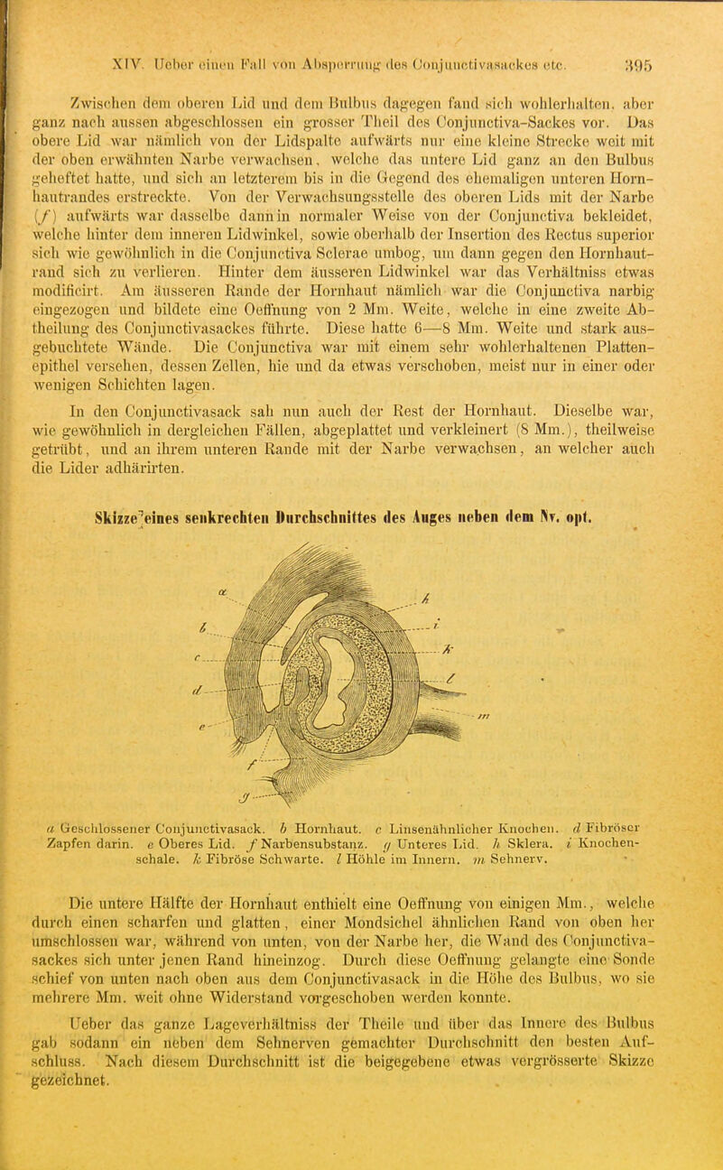 Zwischen dem oberen Lid und dem Bulbus dagegen fand «ich wohlerlialten, aber ganz nach aussen abgeschlossen ein grosser Theil des Conjunctiva-Sackes vor. Das obere Lid war nämlich von der Lidspalte aufwärts nur eine kleine Strecke weit mit der oben erwähnten Narbe verwachsen, welche das untere Lid ganz an den Bulbus geheftet hatte, und sich an letzterem bis in die Gegend des ehemaligen unteren Horn- liautrandes erstreckte. Von der Verwachsungsstelle des oberen Lids mit der Narbe (/') aufwärts war dasselbe dann in normaler Weise von der Conjunctiva bekleidet, welche hinter dem inneren Lidwinkel, sowie oberhalb der Insertion des Rectus superior sich wie gewöhnlich in die Conjunctiva Sclerae umbog, um dann gegen den Hornhaut- rand sich zu verlieren. Hinter dem äusseren Lidwinkel war das Verhältniss etwas moditicirt. Am äusseren Rande der Hornhaut nämlich war die Conjunctiva narbig eingezogen und bildete eine Oefinung von 2 Mm. Weite, welche in eine zweite Ab- theilung des Conjunctivasackes führte. Diese hatte 6—8 Mm. Weite und stark aus- gebuchtete Wände. Die Conjunctiva war mit einem sehr wohlerhaltenen Platten- epithel versehen, dessen Zellen, hie und da etwas verschoben, meist nur in einer oder wenigen Schichten lagen. Li den Conjunctivasack sah nun auch der Rest der Hornhaut. Dieselbe war, wie gewöhnlich in dergleichen Fällen, abgeplattet und verkleinert (8 Mm.), theilweise getrübt, und an ihrem unteren Rande mit der Narbe verwachsen, an welcher auch die Lider adhärirten. Skizze^eines senkrechten Durchschnittes des Auges neben «lern Nr. opt. a Geschlossener Conjunctivasack. b Hornhaut, c Linsenähnlicher Knochen, cl Fibröser Zapfen darin, e Oberes Lid. /Narbensubstanz, y Unteres Lid. h Sklera, i Knochen- schale, k Fibröse Schwarte, l Höhle im Innern, m Sehnerv. Die untere Plälfte der Hornhaut enthielt eine Oeffnung von einigen Mm., welche durch einen scharfen und glatten, einer Mondsichel ähnlichen Rand von oben her umschlossen war, während von unten, von der Narbe her, die Wand des Conjunctiva- sackes sich unter jenen Rand hineinzog. Durch diese Oeffnung gelangte eine Sonde schief von unten nach oben aus dem Conjunctivasack in die Höhe des Bulbus, wo sie mehrere Mm. weit ohne Widerstand voi-geschoben werden konnte. lieber das ganze Lageverhältniss der Theile und über das Innere des Bulbus gab sodann ein nbben dem Sehnerven gemachter Durchschnitt den besten Auf- schluss. Nach diesem Durchschnitt ist die beigegebene etwas vergrösserte Skizze gezeichnet.