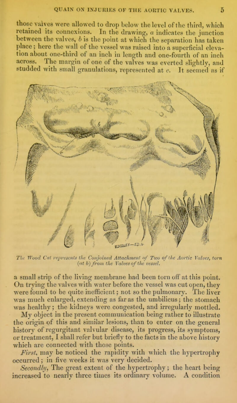 those valves were allowed to drop below the level of the third, which retained its comiexioiis. In the drawin^r, a indicates the junction between the valves, b is the point at which the separation has taken place ; here the wall of the vessel was raised into a superficial eleva- tion about one-third of an inch in length and one-fourth of an inch across. The maroin of one of the valves was everted slightly, and studded with small granulations, represented at c. It seemed as if Tli<: Wood Cut represents t/ie Conjoined Attachment of Two of the Aortic VtUucs, torn (at b) from the Valves of tlie vessel. a small strip of the living membrane had been torn off at this point. On trying the valves with water before the vessel was cut ojien, they were found to be quite inefficient; not so the pulmonary. The liver •Nvas much enlarged, extending as far as the umbilicus; the stomach was healthy; the kidneys were congested, and irregularly mottled. My object in the present communication being rather to illustrate the origin of this and similar lesions, tlian to enter on the general history of regurgitant valvular disease, its progress, its symptoms, or treatment, I shall refer but briefly to the facts in the above history which are connected with those points. First, may be noticed the rapidity with which the hypertrophy occurred; in five weeks it was very decided. Secondbj, The great extent of the hypertrophy; the heart being increased to nearly three times its ordinary volume. A condition