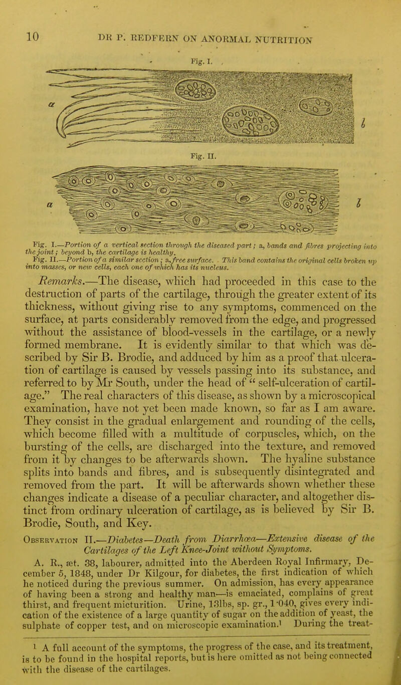 Fig. I. , Fig. I.—Portion of a vertical section through the diseased part; a, hands and fibres prelecting Into the joint; beyond b, the cartilage is healthy. Fig. II—Portion of a similar section; ii,free surface. This hand contains the original cells broken up into masses, or new cells, each one of which has its nucleus. Remarks.—The disease, wHich had proceeded in this case to the destruction of parts of the cartilage, through the gi'eater extent of its thickness, without giving rise to any symptoms, commenced on .the surface, at parts considerably removed from the edge, and progressed wathout the assistance of blood-vessels in the cartilage, or a newly formed membrane. It is evidently similar to that which was de- scribed by Sir B. Brodie, and adduced by him as a proof that ulcera- tion of cartilage is caused by vessels passing into its substance, and referred to by Mr South, under the head of  self-ulceration of cartil- age. The real characters of this disease, as shown by a microscopical examination, have not yet been made known, so far as I am aware. They consist in the gradual enlargement and rounding of the cells, which become filled with a multitude of corpuscles, which, on the bursting of the cells, are discharged into the texture, and removed from it by changes to be afterwards shown. The hyaline substance splits into bands and fibres, and is subsequently disintegrated and removed from the part. It will be afterwards shown whether these changes indicate a disease of a peculiar chai-acter, and altogether dis- tinct from ordinary ulceration of cartilage, as is believed by Sir B. Brodie, South, and Key. Observation II,—Diabetes—Death from Diarrhoea—Extensive disease of the Cartilages of the Left Knee-Joint without Symptoms. A. R., set. 38, labourer, admitted into the Aberdeen Royal Infirmary, De- cember 5, 1848, under Dr Kilgour, for diabetes, the first indication of wiiich he noticed during the previous summer. On admission, has every appearance of having been a strong and healthy man—is emaciated, complains of great thirst, and frequent micturition. Urine, l,3lba, sp. gr., 1 -040, gives every indi- cation of the existence of a large quantity of sugar on the addition of yeast, the sulphate of copper test, and on microscopic examination.' During the treat- i A full account of the symptoms, the progress of the case, and its treatment, is to be found in the hospital reports, but is liere omitted as not being connected with the disease of the cartilages.