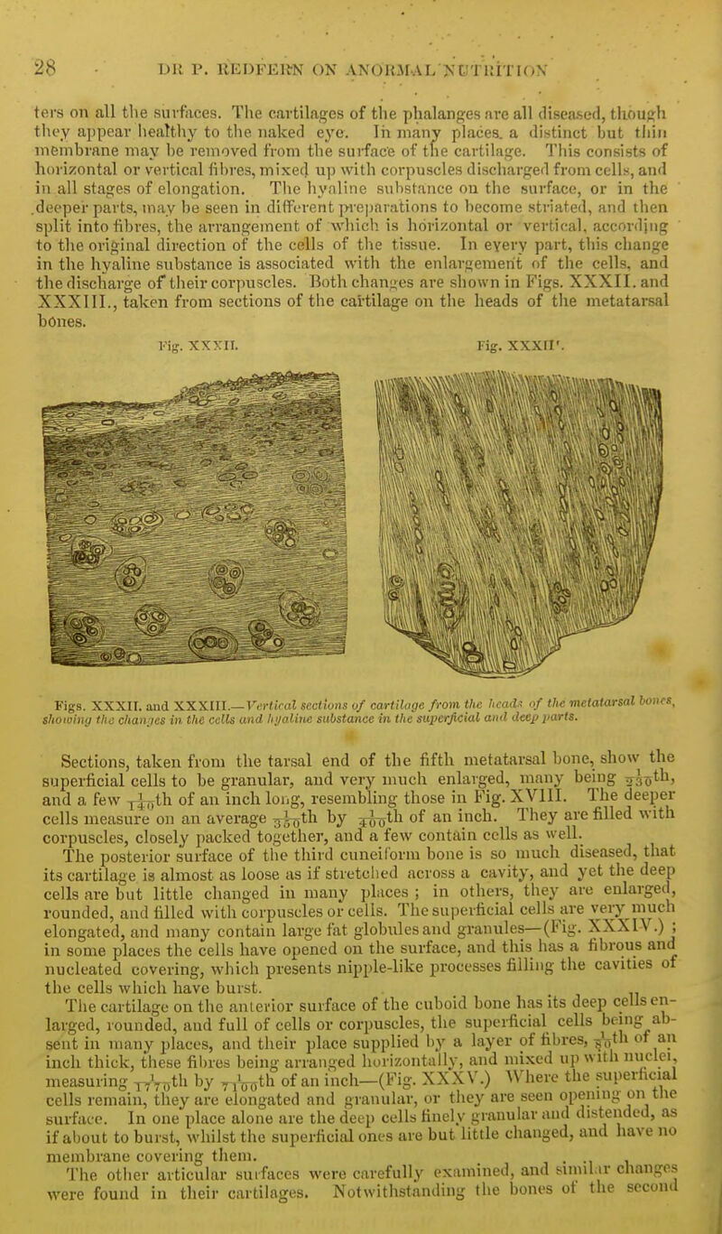 ters on all tlie surfaces. The cartilages of the phalanges are all diseased, though they appear liealthy to tlie naked eye. In many places, a distinct but thin membrane may be removed from the sui'face of the cartilage. This consists of horizontal or vertical fibres, mixed u]) with corpuscles discharged from cells, and in all stages of elongation. The hyaline substance on the surface, or in the .deeper parts, may be seen in different pi-epar.itions to become striated, and then split into fibres, the arrangement of which is horizontal or vertical, according to the original direction of the cells of tlie tissue. In every part, this cliange in the hyaline substance is associated with the enlargement of the cells, and the discharge of their corpuscles. Both changes are shown in Figs. XXXII. and XXXIII., taken from sections of the cartilage on the heads of the metatarsal bones. Fig. XXXII. Fig. xxxir. Figs. XXXII. and XXXlll.— Vurtiral sections of cartilage from tlic lim<U of the metatarsal showiiiy the chanties in tlie cells and hi/aline substance in the superficial and deep i>arts. Sections, taken from the tarsal end of the fifth metatarsal bone, show the superficial cells to be granular, and very much enlarged, many being ^^gotl*' and a few j^th. of an inch long, resembling those in Fig. XVllI. The deeper cells measure on an average ^th by ^^th of an inch. They are filled with corpuscles, closely packed together, and a few contain cells as well. The posterior surface of the third cuneiform bone is so much diseased, that its cartilage ia almost as loose as if stretched across a cavity, and yet the deep cells are but little changed in many places ; in others, they are enlarged, rounded, and filled with corpuscles or cells. The superficial cells are very much elongated, and many contain large fat globules and granules—(Fig. XXXIV.) ; in some places the cells have opened on the surface, and this has a fibrous and nucleated covering, which presents nipple-like processes filling the cavities of the cells which have burst. The cartilage on the anterior surface of the cuboid bone has its deep cells en- larged, rounded, and full of cells or corpuscles, the superficial cells being ab- sent in many places, and their place supplied by a layer of fibres, ^yh of an inch thick, these fibres being arranged horizontally, and mixed up with nuclei, measuring y-^Voth by ^jVath of an inch—(Fig. XXXV.) Where the superficial cells remain, they are elongated and granular, or tliey are seen opening on the surface. In one place alone are the deep cells finely granular and distended, as if about to burst, whilst the superficial ones are but little changed, and have no membrane covering them. . . The otiier articular suifaces were carefully examined, and simil.ir changes were found in their cartilages. Notwithstanding the bones ot the second