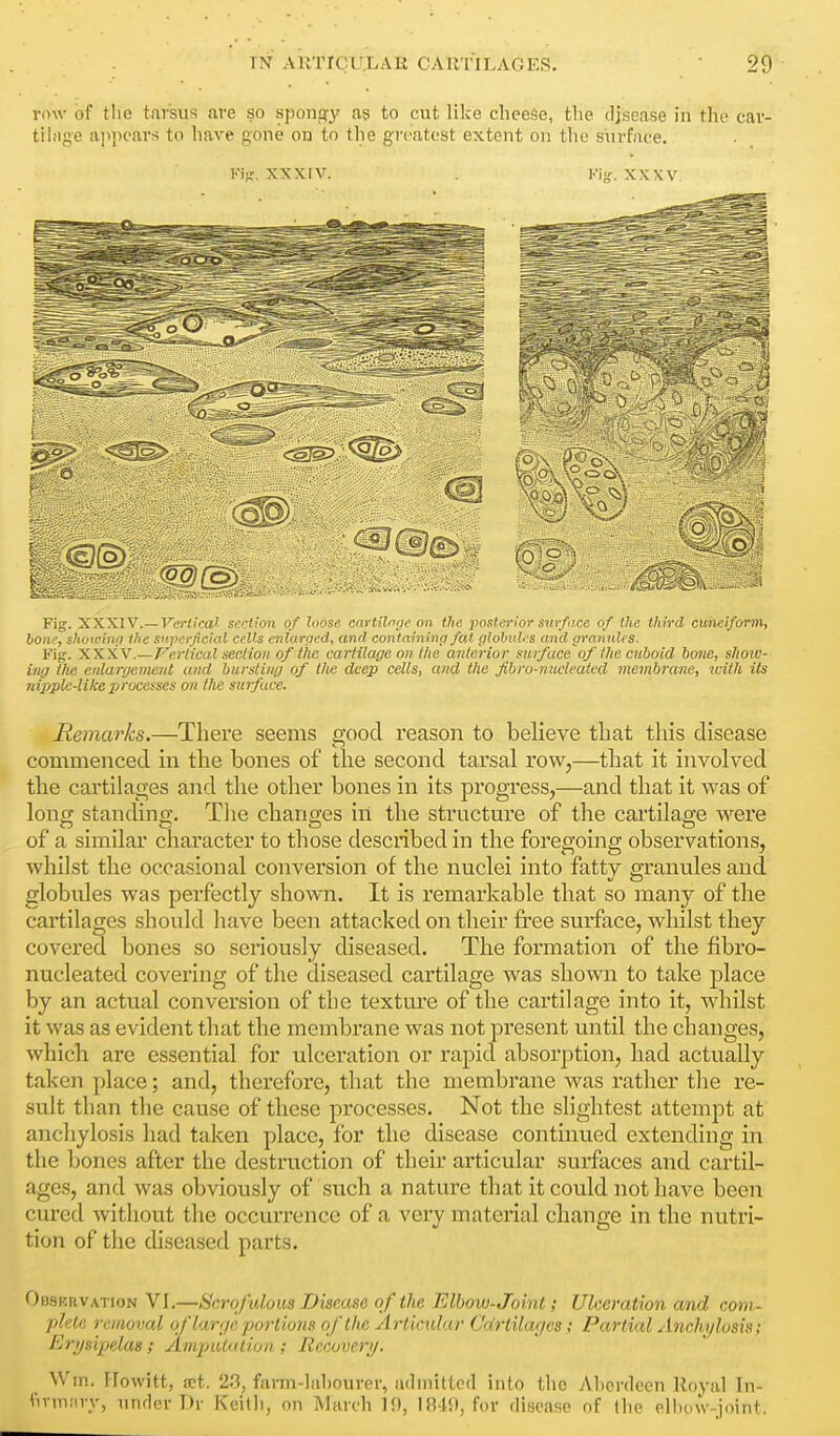 row of tlie tarsus are so spongy as to cut like cheese, the disease in the car- tilage appears to liave gone on to the grt'atest extent on the surf;ice. Kipr. XXXIV. Ki-. XXXV Fig. XXXIV.—Vertical section of loose cartiloric on the posterior surfii.ce of the third cuneiform, hone, showinp the S'ipcrficial cells cnlaraed, and containing fat globuUs and granules. Fig. XXXV.—Vertical section of the cartilage on the anterior stirface of the cuboid bone, show- ing the enlargement and bursting of the deep cells, and the Jibro-nucleatcd membrane, tcith its ?npple-like processes on the suifuce. Remarks.—There seems good reason to believe that this disease commenced in the bones of the second tarsal row,—that it involved the cartilages and the other bones in its progress,—and that it was of long standing. Tlie changes in the structure of the cartilage were of a similar character to those described in the foregoing observations, whilst the occasional conversion of the nuclei into fatty granules and globules was perfectly showai. It is remarkable that so many of the cartilages should have been attacked on their free surface, whilst they covered bones so seriously diseased. The formation of the fibro- nucleated covering of the diseased cartilage was shown to take place by an actual conversion of the texture of the cartilage into it, whilst it was as evident that the membrane was not present until the changes, which are essential for ulceration or rapid absorption, had actually taken place; and, therefoi'e, that the membrane was rather the re- sult than tlie cause of these processes. Not the slightest attempt at anchylosis had taken place, for the disease continued extending in the bones after the destruction of their articular surfaces and cartil- ages, and was obviously of such a nature that it could not have been cured without the occurrence of a very material change in the nutri- tion of the diseased parts. OusRnvATioN VI,—Scrofulous Disease of the Elbow-Joint; Ulceration and com- plete removal of larrje portions of the Articular Cdrtilafjcs; Partial Anchylosis; Erysipelas; AmpiUaiion ; Recovery. Wm. Hewitt, set. 23, fai-m-hihourer, admitted into the Aherdeen Royal In- fn-mnry, nnder T)r Keith, on March 10, IR4!), for disease of the elbow-joint.