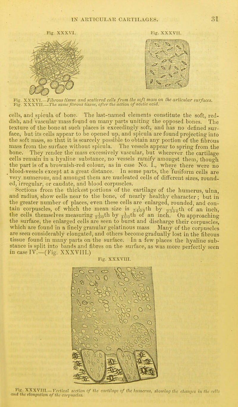 Fig XXXVI. Fig. XXXVII. Fig. XXXVI.—K6ro!« Hssm and scattered cells from the soft mass on the articular surfaces. Fig. XXXVII.— The same fibrous tissue, after the action of acetic acid. cells, and spicula of bone. The last-named elements constitute the soft, red- dish, and Vascular mass found on many parts uniting the opposed bones. The texture of the bone at such places is exceedingly soft, and has no defined sur- face, but its cells appear to be opened up, and spicula are found projecting into the soft mass, so that it is scarcely possible to obtain any portion of the fibi'ous mass from the surface without spicula. The vessels appear to spring from the bone. They render the mass excessively vascular, but wherever the cartilage cells remain in a hyaline substance, no vessels ramify amongst them, though the part is of a brownish-red colour, as in case No. I., where there were no _ blood-vessels except at a great distance. In some parts, the fusiform cells are very numerous, and amongst them are nucleated cells of different sizes, round- ed, irregular, or caudate, and blood corpuscles. Sections from the thickest portions of the cartilage of the humerus, ulna, and radius, show cells near to the bone, of nearly healthy character; but in the greater number of places, even these cells are enlarged, rounded, and con- tain corpuscles, of which the mean size is y^'o^th by g^-Qth of an inch, the cells themselves measuring ^^th by ^^th of an inch. On approaching the surface, the enlarged cells are seen to burst and discharge their corpuscles, which are found in a finely granular gelatinous mass Many of the corpuscles are seen considerably elongated, and others become gradually lost in the fibrous tissue found in many parts on the surface. In a few places the hyaline sub- stance is split into bands and fibres on the surface, as was more perfectly seen in case IV.—(Fig. XXXVIII.) Fig. XXXVIII. ^ «og ^^^^ Fig. XXXVJII.—Kfii-d'cdl section nf the cartilage of the humcrns, shomng the changes in the ecVs and the elongation of the cori'uscles.