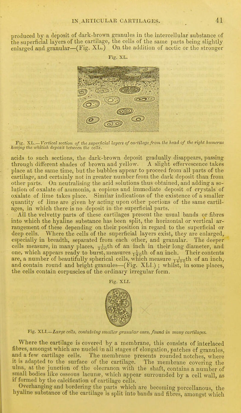 produced by a deposit of davk-brown granules in the intercellular substance of tlie superficial layers of the cartilage, the cells of the same parts being slightly enlarged and granular—(Fig- XL.) On the addition of acetic or the stronger Fig. XL. Fig. XL.— Vertical section of the superficial layers of cartilage from the head of the right humerus having the whitish deposit between the cells. acids to such sections, the dark-brown deposit gradually disappears, passing through different shades of brown and yellow. A slight effervescence takes place at the same time, but the bubbles appear to proceed from all parts of the cartilage, and certainly not in greater number from the dark deposit than from other parts. On neutralising the acid solutions thus obtained, and adding a so- lution of oxalate of ammonia, a copious and immediate deposit of crystals of oxalate of lime takes place. Similar indications of the existence of a smaller quantity of lime are given by acting upon other portions of the same cartil- ages, in which there is no deposit in the superficial parts. All the velvetty parts of these cartilages present the usual bands or fibres into which the hyaline substance has been split, the horizontal or vertical ar- rangement of these depending on their position in regard to the superficial or deep cells. Where the cells of the supei-ficial layers exist, they are enlarged, especially in breadth, separated from each other, and granular. The deeper cells measure, in many places, 2(h)*^^ inch, in their long diameter, and one, which appears ready to burst, measures y^oth of an inch. Their contents are, a number of beautifully spherical cells, which measure j^ro^th of an inch, and contain round and bright granules—(Fig. XLI.) ; whilst, in some places, the cells contain corpuscles of the ordinary irregular form. Fig. XLI. Fig. Xhl.—Large cells, containing smaller granular ones, found in many carlilages. Where the cartilage is covered by a membrane, this consists of interlaced fibres, amongst which are nuclei in all stages of elongation, patches of granules, and a few cartilage cells. The membrane presents rounded notches, where it is adapted to the surface of the cartilage. Tiie membrane covering the ulna, at the junction of the olecranon with the shaft, contains a number of small bodies like osseous lacuna?, wliich appear surrounded by a cell wall, as if formed by the calcification of cartilage cells. Overhanging and bordering the parts which are becoming porcellanous, the hyahne substance of the cartilage is split into bands and fibres, amongst which