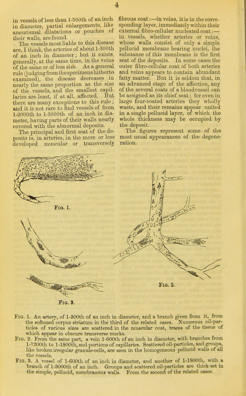 in vessels of less than l-500tli of an inch in diameter, partial enlai-gements, like aneurismal dilatations or pouches of their walls, are found. The vessels most Uable to tliis disease ai-e, I think, the ai-teries of about l-300th of an inch in diameter; but it exists, generally, at the same time, in the veins of the same or of less size. As a general rule (judgiag from the specimens hitherto examined), the disease decreases iu neai-ly the same proportion as the size of the vessels, and the smallest capil- laries ai-e least, if at all, affected. But there ai-e many exceptions to this rvde; and it is not rai-e to find vessels of fi-om l-2000th to l-3000th of an inch in dia- meter, having parts of their walls nearly covered with the abnonnal deposits. The principal and fii-st seat of the de- posits is, in arteries, in the more or less developed muscular- or transversely FiO. 3. fibrous coat:—in veins, it is in the corre- sponding layer, immediately within tlieir external fibro-cellular nucleated coat:— in vessels, whether arteries or veins, whose walls consist of only a simple peUucid membrane beaiing nuclei, the substance of this membrane is the first seat of the deposits. In some cases the outer fibro-cellular coat of both arteries and veins appears to contain abundant fatty matter. But it is seldom that, in an advanced stage of the affection, any of the several coats of a bloodvessel can be assigned as its chief seat; for even in large four-coated arteries they wholly waste, and their remains appear united in a single pellucid layer, of which the whole thickness may be occupied by the deposit. The figures represent some of the most usual appeai'ances of the degene- ration. Fig. 2. FlS. 1. An artery, of l-300th of an inch in diameter, and a branch given from it, from the softened corpuB Btriatiun in the third of the related cases. Numerous oil-par- ticles of various sizes arc scattered in the muscular coat, traces of the tissue of which appear in obscure transverse marks. Fig. 2. Pi-om the same part, a vein l-600th of an inch in diameter, with branches from 1-1200th to l-1800th, and portions of capillaries. Scattered oil-particles, and groups, like broken irregular granule-cells, ore seen in the homogeneous peUucid walls of aU the vessels. Fig. 3. A vessel of l-600th of an inch in diameter, and another of l-1800th, with a branch of l-3000th of an inch. Groups and scattered oil-particles are thick-set in the simple, pellucid, membranous walls. From the second of the related cases.