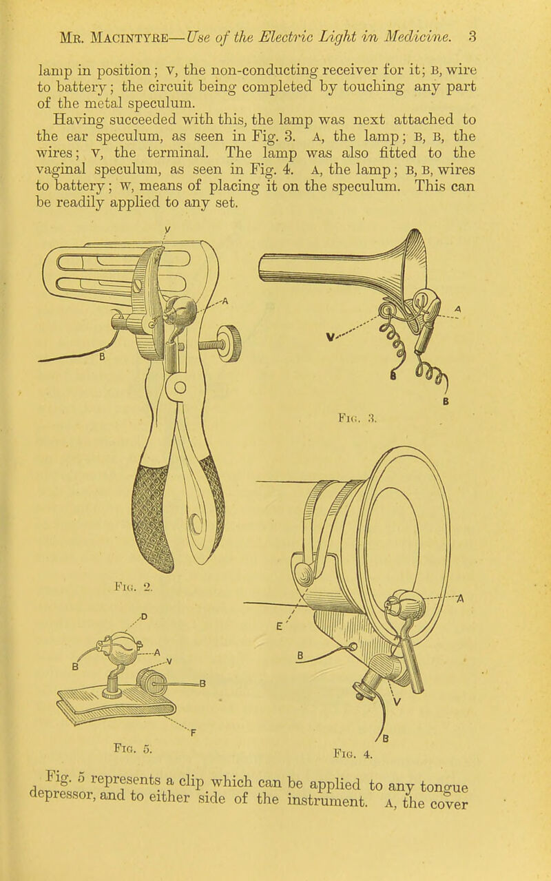 lamp in position; v, the non-conducting receiver for it; B, wire to battery; the circuit being completed by touching any part of the metal speculum. Having succeeded with this, the lamp was next attached to the ear speculum, as seen in Fig. 3. A, the lamp; B, B, the wires; v, the terminal. The lamp was also fitted to the vaginal speculum, as seen in Fig. 4. A, the lamp; B, B, wires to battery; w, means of placing it on the speculum. This can be readily applied to any set. Fin. 5. —ft—A Fig. 4. Fig. 5 represents a clip which can be applied to any tono-ue depressor, and to either side of the instrument. A the & cover