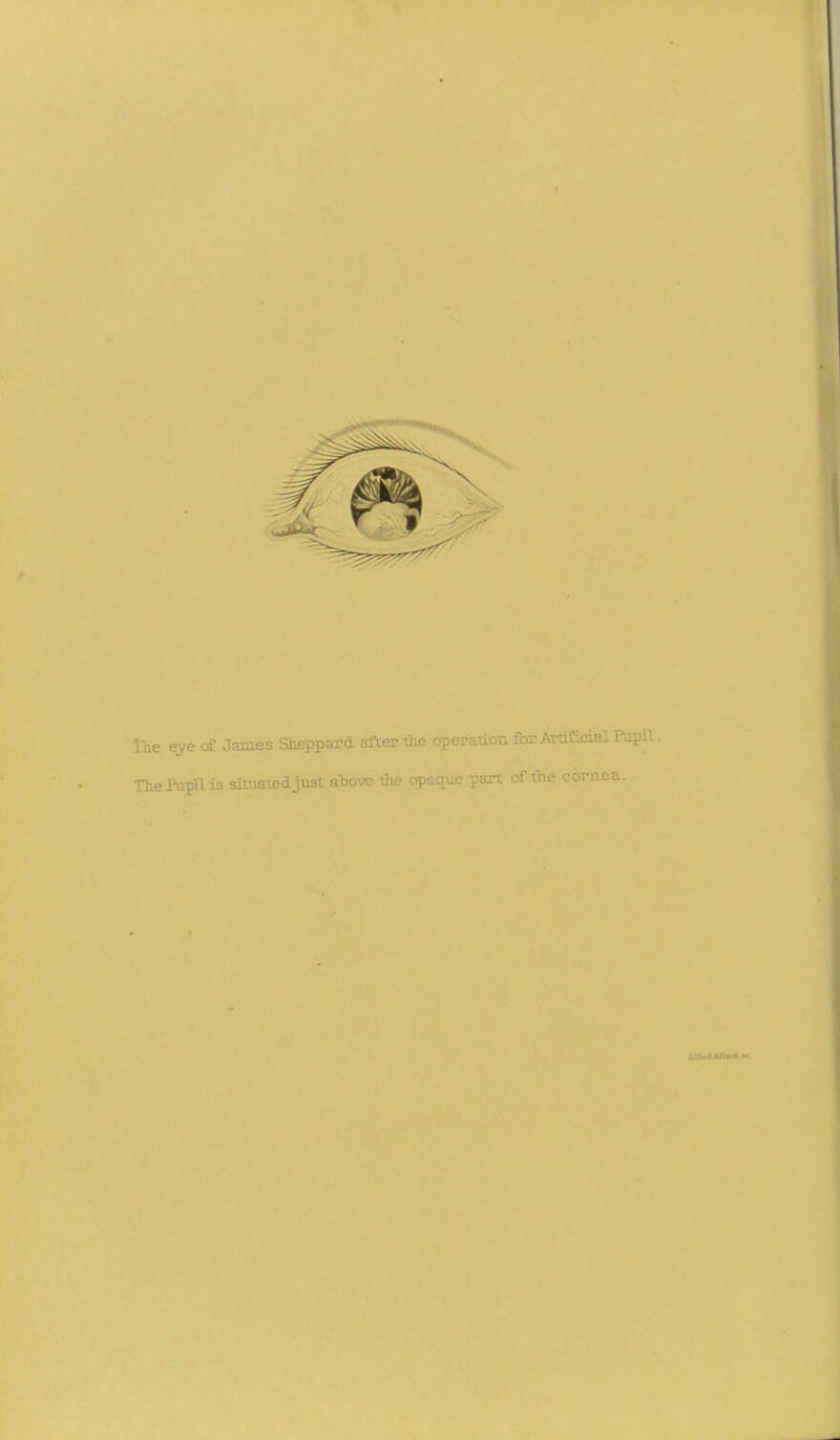 tae eye cf Jaiaes Slieppaxd after the operatLonforATtifici ^ The !' :ril - ■situatedjust atovc ihe opactuc part of the cornea.