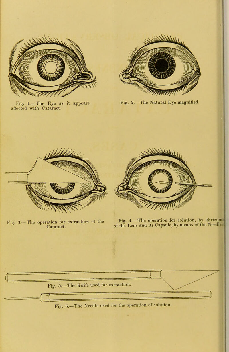 Fig. I.— The Eye ns it appears aft'ected with Cataract. Fig. 2.—The Natural Eye magnified. Fig. 3.-The operation for extraction of the Fig. 4.-The operation for solution, by divisioiii Cataract. of the Lens and its Capsule, by means of the Needl&e c pjg. 5.—The Knife used for extraction 4Z □ Pig. G. The Needle used for the operation of solution.