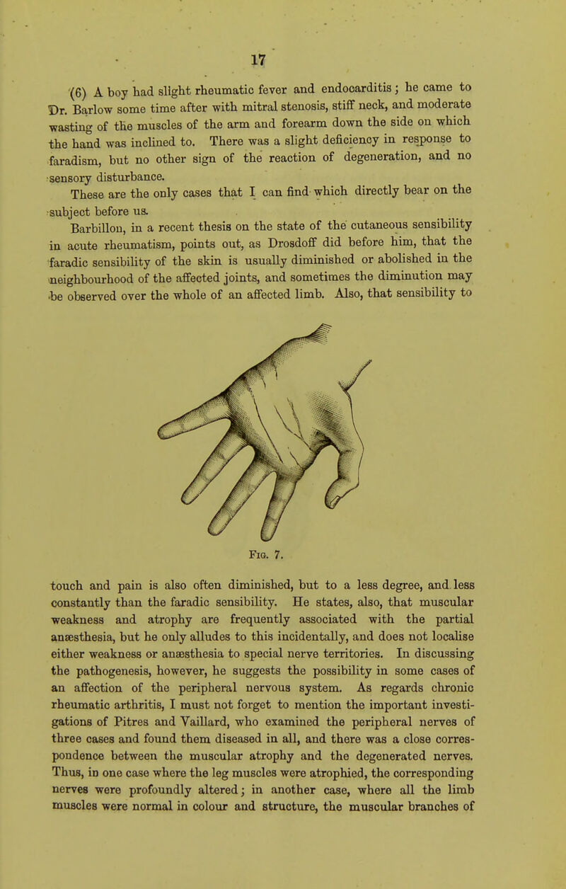 (6) A boy had slight rheumatic fever and endocarditis; he came to Dr. Barlow some time after with mitral stenosis, stiff neck, and moderate wasting of the muscles of the arm and forearm down the side on which the hand was inchned to. There was a slight deficiency in response to faradism, but no other sign of the reaction of degeneration, and no •sensory disturbance. These are the only cases that I can find which directly bear on the •subject before ua. Barbillou, in a recent thesis on the state of the cutaneous sensibility in acute rheumatism, points out, as Drosdoff did before him, that the faradic sensibility of the skin is usually diminished or abolished in the ■neighbourhood of the affected joints, and sometimes the diminution may •be observed over the whole of an affected limb. Also, that sensibility to Fio. 7. touch and pain is also often diminished, but to a less degree, and less constantly than the faradic sensibility. He states, also, that muscular weakness and atrophy are frequently associated with the partial anaesthesia, but he only alludes to this incidentally, and does not locaUse either weakness or anaesthesia to special nerve territories. In discussing the pathogenesis, however, he suggests the possibility in some cases of an affection of the peripheral nervous system. As regards chronic rheumatic arthritis, I must not forget to mention the important investi- gations of Pitres and Vaillard, who examined the peripheral nerves of three cases and found them diseased in all, and there was a close corres- pondence between the muscular atrophy and the degenerated nerves. Thus, in one case where the leg muscles were atrophied, the corresponding nerves were profoundly altered; in another case, where all the limb muscles were normal in colour and structure, the muscular branches of