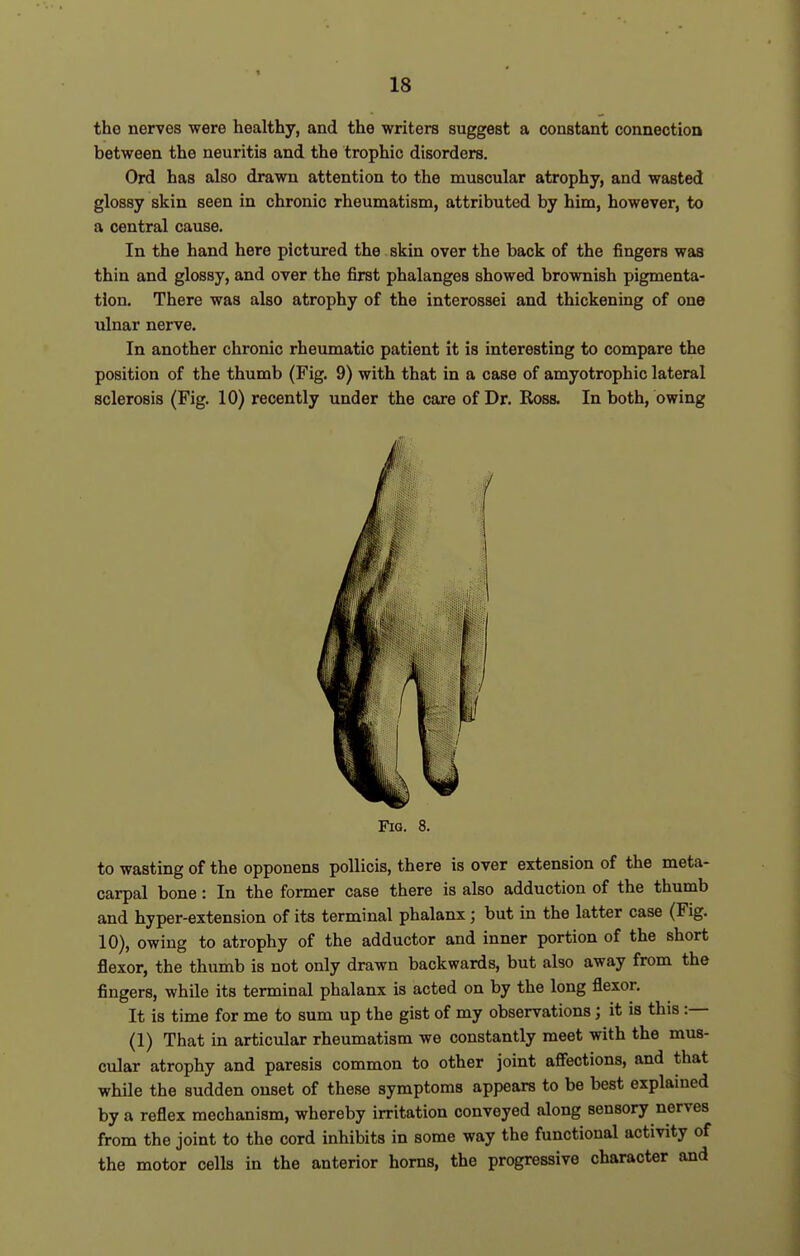 18 the nerves were healthy, and the writers suggest a constant connection between the neuritis and the trophic disorders. Ord has also drawn attention to the muscular atrophy, and wasted glossy skin seen in chronic rheumatism, attributed by him, however, to a central cause. In the hand here pictured the skin over the back of the fingers was thin and glossy, and over the first phalanges showed brownish pigmenta- tion. There was also atrophy of the interossei and thickening of one ulnar nerve. In another chronic rheumatic patient it is interesting to compare the position of the thumb (Fig. 9) with that in a case of amyotrophic lateral sclerosis (Fig. 10) recently under the care of Dr. Ross. In both, owing Fig. 8. to wasting of the opponens poUicis, there is over extension of the meta- carpal bone: In the former case there is also adduction of the thumb and hyper-extension of its terminal phalanx; but in the latter case (Fig. 10), owing to atrophy of the adductor and inner portion of the short flexor, the thumb is not only drawn backwards, but also away from the fingers, while its terminal phalanx is acted on by the long flexor. It is time for me to sum up the gist of my observations; it is this :— (1) That in articular rheumatism we constantly meet with the mus- cular atrophy and paresis common to other joint affections, and that while the sudden onset of these symptoms appears to be best explained by a reflex mechanism, whereby irritation conveyed along sensory nerves from the joint to the cord inhibits in some way the functional activity of the motor cells in the anterior horns, the progressive character and