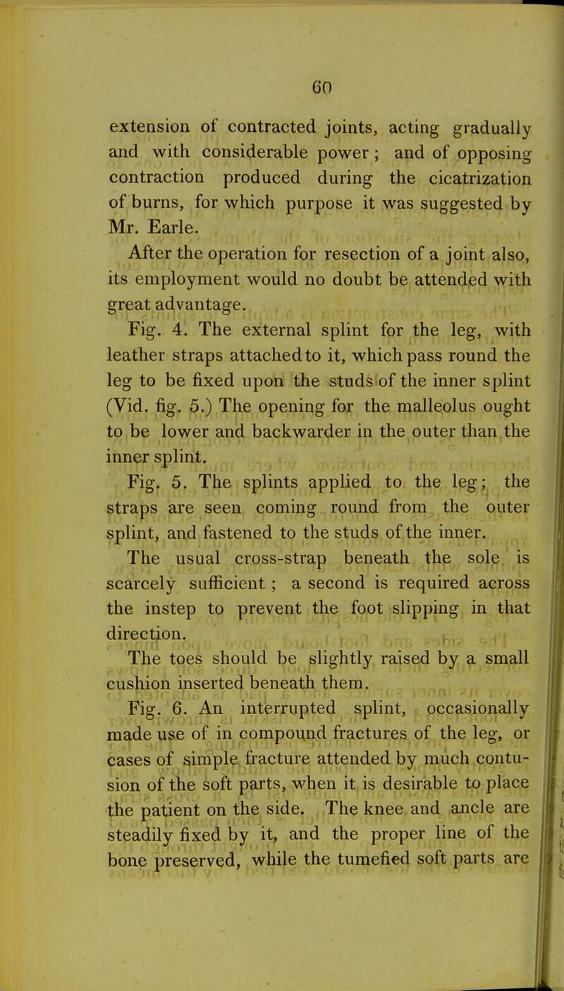 extension of contracted joints, acting gradually and with considerable power; and of opposing contraction produced during the cicatrization of burns, for which purpose it was suggested by Mr. Earle. After the operation for resection of a joint also, its employment would no doubt be attended with great advantage. Fig. 4. The external splint for the leg, with leather straps attached to it, which pass round the leg to be fixed upon the studs of the inner splint (Vid. fig. 5.) The opening for the malleolus ought to be lower and backwarder in the outer than the inner splint. Fig. 5. The splints applied to the leg; the straps are seen coming round from the outer splint, and fastened to the studs of the inner. The usual cross-strap beneath the sole is scarcely sufficient ; a second is required across the instep to prevent the foot slipping in that direction. , , , . ,, .. The toes should be slightly raised by a small cushion inserted beneath them. Fig. 6. An interrupted splint, occasionally made use of in compound fractures of the leg, or cases of simple fracture attended by much contu- sion of the soft parts, when it is desirable to place the patient on the side. The knee and ancle are steadily fixed by it, and the proper line of the bone preserved, while the tumefied soft parts are