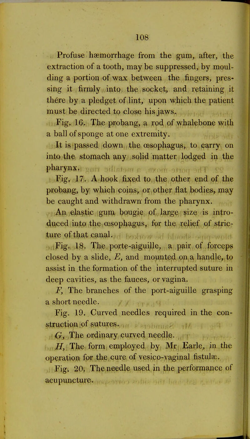 . Profuse haemorrhage from the gum, after, the extraction of a tooth, may be suppressed, by moul- ding a portion of wax between the fingers, pres- sing it firmly into, the socket, and retaining it there by a pledget of lint, upon which the patient must be directed to close his jaws. ,Fig. 16. The probang, a rod of whalebone with a ball of sponge at one extremity. It is passed down the oesophagus, to carry on into the stomach any solid matter lodged in the pharynx. Fig, 17. A hook fixed to the other end of the probang, by which coins, or other flat bodies, may be caught and withdrawn from the pharynx. An elastic gum bougie of large size is intro- duced into the oesophagus, for the relief of stric- ture of that canal. ., iFig. 18. The porte-aiguille, a pair of forceps closed by a slide, E, and mounted on a handle, to assist in the formation of the interrupted suture in deep cavities, as the fauces, or vagina. F, The branches of the port-aiguille grasping a short needle. Fig. 19. Curved needles required in the con- struction of sutures. G, The ordinary curved needle. i-.: H, The form employed by Mr Earle, in the operation for the cure of vesico-vaginal fistulae. Fig. 20. The needle used in the performance of acupuncture.