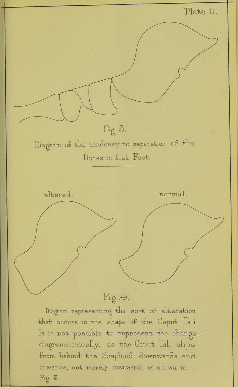 Tl-ate 11 ■^lirered. normal. Fic?..4^ Diagram represen.fein.^ -tke sort of? al-tierafeion occurs in. tKe sKape bke Caput, Tali. It IS not possible to represent tke clian-ge diagrammati-cally, -as tlte Caput Tali slips I'rom iDelimd tlte Scaphoid oLownwaraLs an3- mwards, not merely downwards as sKewn in ¥i6 Z