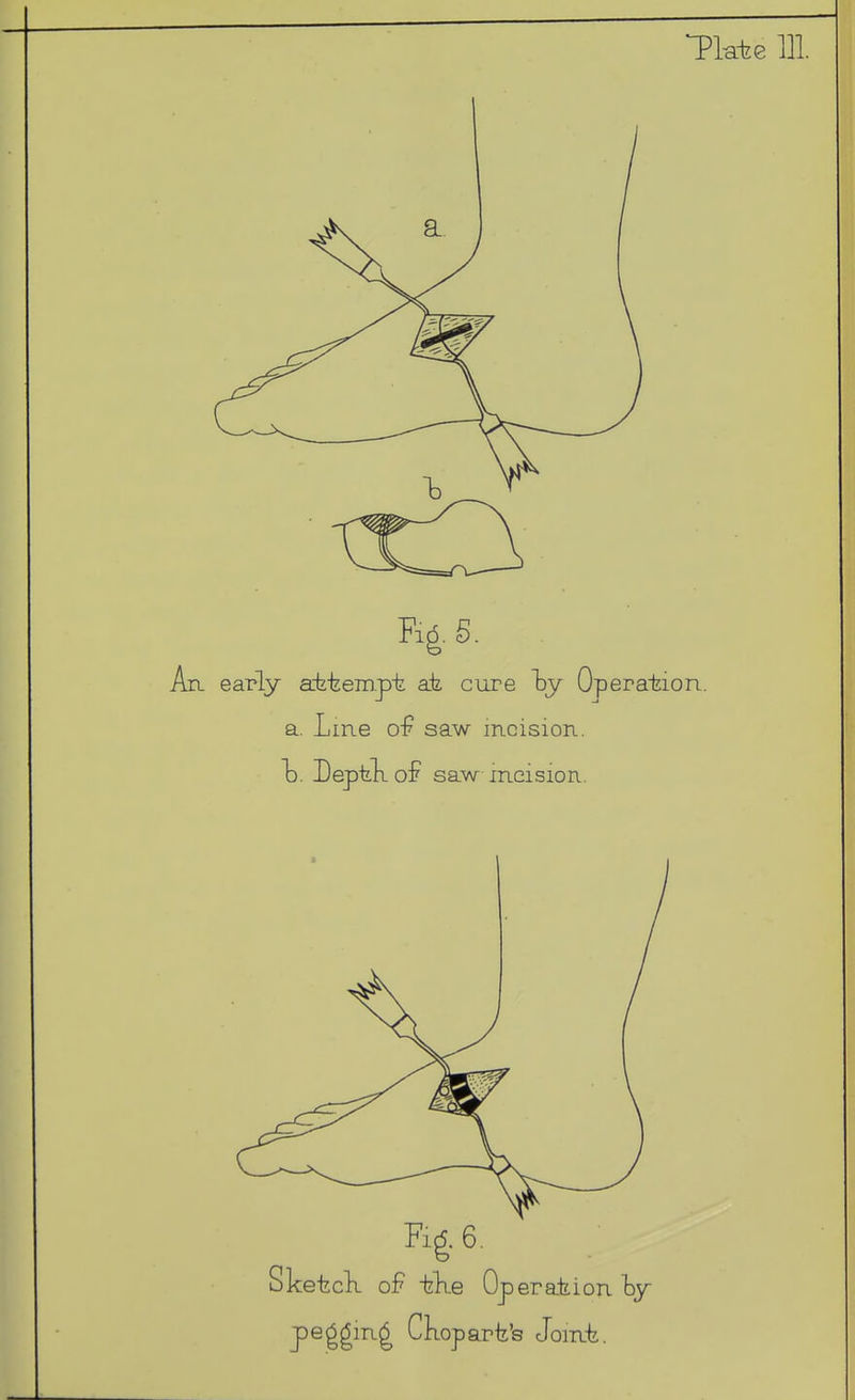 Tkte HI Rg. 6, SketcK of izKe Operaiiion pegging Ckoparfe's Jonit.