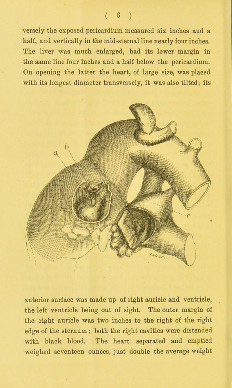 versely the exposed pericardium measured six inches and a half, and vertically in the mid-sternal line nearly four inches. The liver was much enlarged, had its lower margin in the same line four inches and a half below the pericardium. On opening the latter the heart, of large size, was placed with its longest diameter transversely, it was also tilted; its anterior surface was made up of right auricle and ventricle, the left ventricle being out of sight. The outer margin of the right auricle was two inches to the right of the right edge of the sternum; both the right cavities were distended with black blood. The heart separated and emptied weighed seventeen ounces, just double the average weight