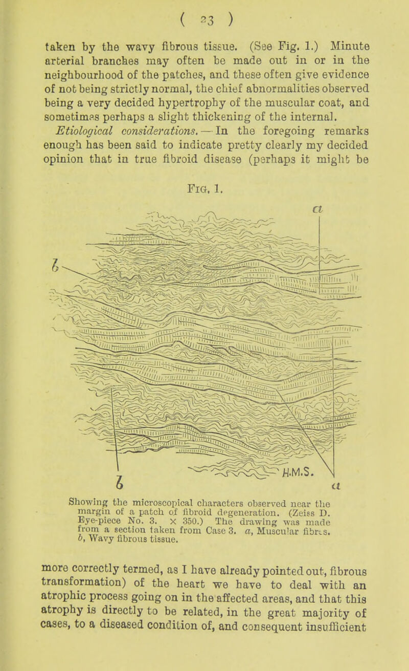 taken by the wavy fibrous tissue. (See Fig. 1.) Minute arterial branches may often be made out in or in the neighbourhood of the patches, and these often give evidence of not being strictly normal, the chief abnormalities observed being a very decided hypertrophy of the muscular coat, and sometimfls perhaps a slight thickening of the internal. Etiological considerations. — In the foregoing remarks enough has been said to indicate pretty clearly my decided opinion that iu true fibroid disease (parhaps it might be Fig. 1. Showing the microscopical characters observed near the margin of a patch of fibroid degeneration. (Zeiss D. Eye-piece No. 3. X 350.) The drawing was made from a section taken from Case 3. a, Muscu'ar fibres. b, Wavy fibrous tissue. more correctly termed, as I have already pointed out, fibrous transformation) of the heart we have to deal with an atrophic process going on in the affected areas, and that this atrophy is directly to be related, in the great majority of cases, to a diseased condition of, and consequent insufficient