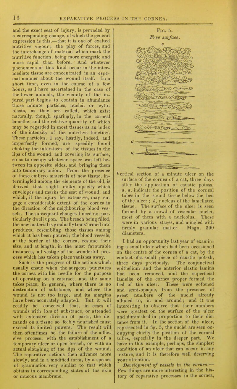 and the exart seat of injury, is pervaded by a corresponding change, of which the general expression is this,—that it is one of exalted nutritive vigour ; the play of forces, and the interchange of material which mark the iiutrilive function, being more energetic and more rapid than before. And whatever phenomena of this kind occur in the inter- mediate tissue are concentrated in an espe- cial manner about the wound itself. In a short time, even in the course of a few hours, as 1 have ascertained in the case of the lower animals, the vicinity of the in- jured part begins to contain in abundance those minute particles, nuclei, or cyto- blasts, as they arf, called, which exist naturally, though sparingly, in the corneal lamellae, and the relative quantity of which may be regarded in most tissues as an index of the intensity of the nutritive function. These particles, I say, hastily, indeed, and imperfectly formed, are speedily found choking the interstices of the tissues in the lips of the wound, and covering its surface, so as to occupy whatever space was left be- tween its opposite sides, and bringing them into temporary union. From the presence of these embryo materials of new tissue, in- termingled among the elements of the old, is derived that slight milky opacity which envelopes and marks the seat of wound, and which, if the injury be extensive, may en- gage a considerable extent of the cornea in the direction of the neighbouring blood-ves- sels. The subsequent changes I need not par- ticularly dwell upon. The breach being filled, the new material is gradually trans''ormed into products, resembling those tissues among which it has been poured ; the blood-vessels, at the border of the ccrnea, resume their size, and at length, in the most favourable instances, all vestige of the wonderful pro- cess which has taken place vanishes away. Such is the progress of the actious which usually ensue when the surgeon punctures the cornea with his needle for the purpose of operating on a cataract, and the same takes piace, in general, where there is no destruction of substance, and where the wound is not too large, and its margins have been accurately adapted. But it will readily be conceived that, in cases of wounds with lo s of substance, or attended with extensive division ol jjarts, the de- mands on a tissue so feebly nourished must exceed its limited powers. The result will then oftentimes be the failure of the adhe- sive process, with the establishment of a temporary ulcer or open breach, or with an actual sloughing of the lips of the wound. The reparative actions then advance more slowly, and in a modified form, by a species of granulation very similar to diat which obtains in corresponding slates uf the skin or mucous meuibraue. Fig. 5. Free surface, c Vertical section of a minute ulcer on the surface of the cornea of a cat, three days alter the application of caustic potass. a, a, indicate the position of the corneal tubes in the sound tissue below the bed of the ulcer ; b, nucleus of the lamellated tissue. The surface of the ulcer is seen formed by a crowd of vesicular nuclei, most of them with a nucleolus. These were in various stages, and n'.ingled with firmly granular matter. Magn. 300 diameters. I had an opportunity last year of examin- ing a small ulcer which had be- n occasioned on the centre of the cornea of a cat, by the contact of a small piece of caustic potrsh, three days previously. The conjunctival epithelium and the anterior elastic lamina had been removed, and the superficial lamellae of the cornea proper formed the bed of the ulcer. These were softened and semi-opaque, from the presence of great numbers of the nuclei already alluded to, in and around; and it was interesting to observe that their numbers were greatest on the surface of the ulcer and diminished in proportion to their dis- tance from it. In the section of the ulcer, rej)resented in fig. 5, the nuclei are seen oc- cupying chiefly the position of the corneal tubes, especially in the deeper part. We have in this example, perhaps, the simplest condition of an ulcer that can occur in any texture, and it is therefore well deserving your attention. Development of vessels in the cornea.— Few things are more interesting in the his- tory of reparative processes iu the cornea,