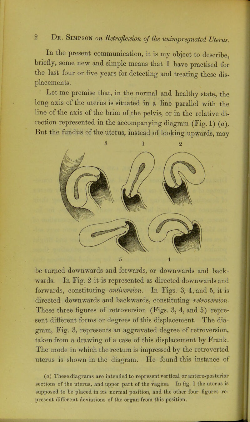 In the present communication, it is my object to describe, briefly, some new and simple means that I have practised for the last four or five years for detecting and treating these dis- placements. Let me premise that, in the normal and healthy state, the long axis of the uterus is situated in a line parallel with the line of the axis of the brim of the pelvis, or in the relative di- rection represented in the accompanying diagram (Fig. 1) (a). But the fundus of the uterus, instead of looking upwards, may 3 1 2 5 4 be turned downwards and forwards, or downwards and back- wards. In Fig. 2 it is represented as directed downwards and forwards, constituting aniiversion. In Figs. 3, 4, and 5, it is directed downwards and backwards, constituting retroversion. These three figures of retroversion (Figs. 3, 4, and 5) repre- sent different forms or degrees of this displacement. The dia- gram. Fig. 3, represents an aggravated degree of retroversion, taken from a drawing of a case of this displacement by Frank. The mode in which the rectum is impressed by the retro verted uterus is shown in the diagram. He found this instance of (a) These diagrams are intended to represent vertical or antero-postcrior sections of the uterus, and upper part of the vagina. In fig. 1 the uterus is supposed to bo placed in its normal position, and the other four figures re- present different deviations of the organ from this position.