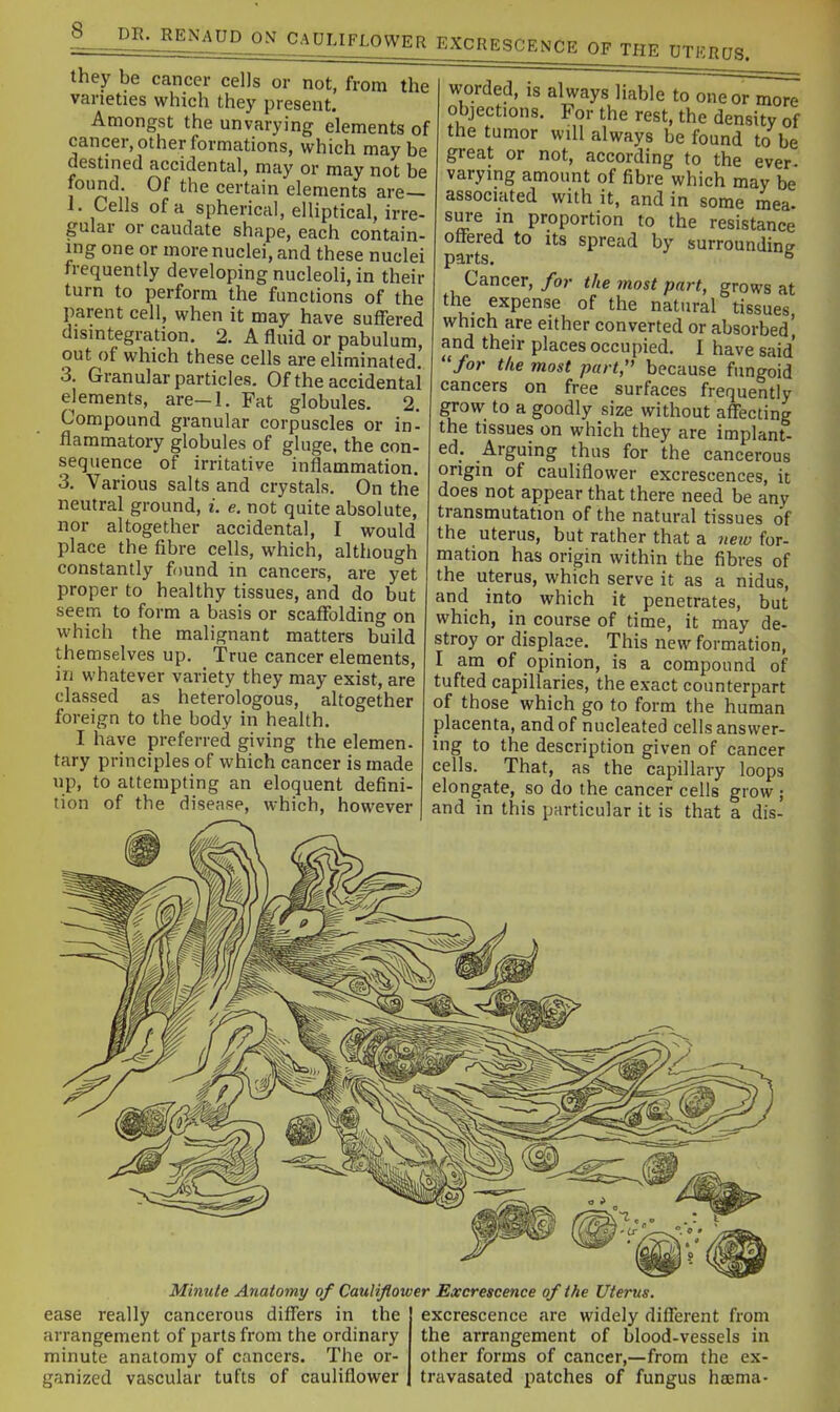 LOWER EXCRESCENCE OF THE UTERUS. they be cancer cells or not, from the varieties which they present. Amongst the unvarying elements of cancer, other formations, which maybe destined accidental, may or may not be toimd Of the certain elements are— 1. Cells of a spherical, elliptical, irre- gular or caudate shape, each contain- ing one or more nuclei, and these nuclei frequently developing nucleoli, in their turn to perform the functions of the parent cell, when it may have suffered disintegration. 2. A fluid or pabulum, out of which these cells are eliminated, 3. Granular particles. Of the accidental elements, are-1. Fat globules. 2. Compound granular corpuscles or in- flammatory globules of gluge, the con- sequence of irritative inflammation. 3, Various salts and crystals. On the neutral ground, i. e. not quite absolute, nor altogether accidental, I would place the fibre cells, which, although constantly found in cancers, are yet proper to healthy tissues, and do but seem to form a basis or scaffolding on which the malignant matters b'uild themselves up. True cancer elements, in whatever variety they may exist, are classed as heterologous, altogether foreign to the body in health. I have preferred giving the elemen- tary principles of which cancer is made up, to attempting an eloquent defini- tion of the disease, which, however worded, IS always liable to one or more objections. For the rest, the density of the tumor will always be found to be great or not, according to the ever varying amount of fibre which may be associated with it, and in some mea. sure in proportion to the resistance offered to its spread by surrounding Cancer, for the most part, grows at u- PP^^^ of the natural tissues which are either converted or absorbed' and their places occupied. I have said for the most part, because fungoid cancers on free surfaces frequently grow to a goodly size without affecting the tissues on which they are implant- ed. Arguing thus for the cancerous origin of cauliflower excrescences, it does not appear that there need be any transmutation of the natural tissues of the uterus, but rather that a iieiv for- mation has origin within the fibres of the uterus, which serve it as a nidus, and into which it penetrates, but which, in course of time, it may de- stroy or displace. This new formation, I am of opinion, is a compound of tufted capillaries, the exact counterpart of those which go to form the human placenta, and of nucleated cells answer- ing to the description given of cancer cells. That, as the capillary loops elongate, so do the cancer cells grow ; and in this particular it is that a dis- Minute Anatomy of Cauliflower Excrescence of the Uterus. ease really cancerous differs in the arrangement of parts from the ordinary minute anatomy of cancers. The or- ganized vascular tufts of cauliflower excrescence are widely different from the arrangement of blood-vessels in other forms of cancer,—from the ex- travasated patches of fungus haema-