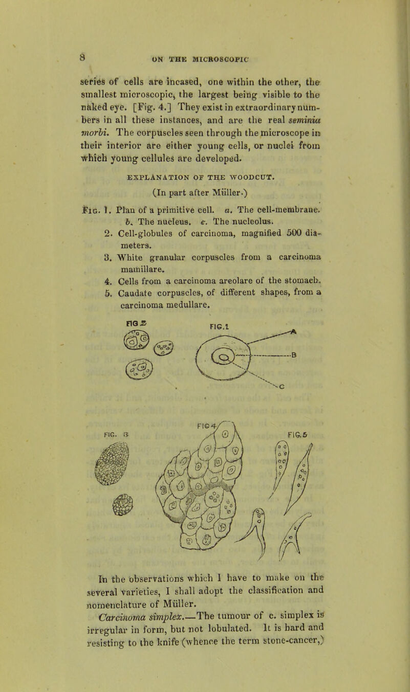 sefies of cells are incased, one within the other, the smallest microscopic, the largest being visible to the nfakedeye. [Fig. 4.] They exist in extraordinary num- bers in all these instances, and are the real seminia morhi. The corpuscles seen through the microscope in their interior are either young cells, or nuclei from which young cellules are developed. EXPLANATION OF THE WOODCUT. (In part after Miiller.) iiG. 1. Plan of a primitive cell. a. The cell-membrane. 6. The nucleus, e. The nucleolus. 2. Cell-globules of carcinoma, magnified 500 dia- meters. 3. White granular corpuscles from a carcinoma mamillare. 4. Cells from a carcinoma areolare of the stomach. 5. Caudate corpuscles, of different shapes, from a carcinoma medullare. hi the observations which 1 have to make on the several varieties, I shall adopt the classification and nomenclature of Miiller. Carcinoma simplex The tumour of c. simplex is irregular in form, but not lobulated. It is hard and resisting to the knife (whence the term stone-cancer,)