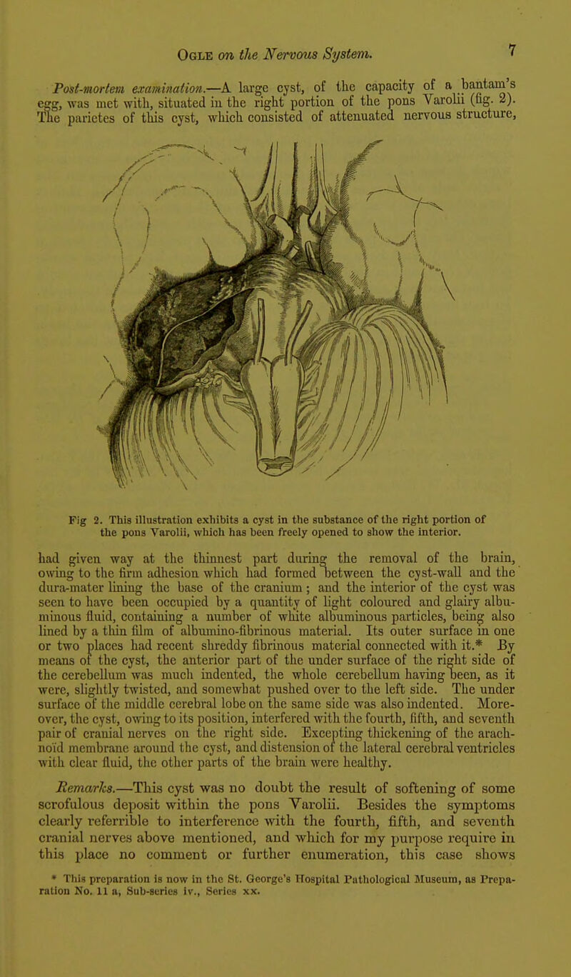 Post-mortem examination.—A large cyst, of the capacity of a bantam's egg, was met with, situated in the right portion of the pons Varolii (fag. 2). The parietes of this cyst, which consisted of attenuated nervous structure, Fig 2. This illustration exhibits a cyst in the substance of the right portion of the pons Varolii, which has been freely opened to show the interior. had given way at the thinnest part during the removal of the brain, owing to the firm adhesion which had formed between the cyst-wall and the dura-mater lining the base of the cranium ; and the interior of the cyst was seen to have been occupied by a quantity of light coloured and glairy albu- minous fluid, containing a number of white albuminous particles, being also lined by a thin film of albumino-fibrinous material. Its outer surface m one or two places had recent shreddy fibrinous material connected with it.* By means ot the cyst, the anterior part of the under surface of the right side of the cerebellum was mucli indented, the whole cerebellum having been, as it were, slightly twisted, and somewhat pushed over to the left side. The under surface of the middle cerebral lobe on the same side was also indented. More- over, the cyst, owing to its position, interfered with the fourth, fifth, and seventh pair of cranial nerves on the right side. Excepting thickening of the arach- noid membrane around the cyst, and distension of the lateral cerebral ventricles with clear fluid, the other parts of the brain were healthy. Remarks.—This cyst was no doubt the result of softening of some scrofulous deposit within the pons Varolii. Besides the symptoms clearly referrible to interference with the fourth, fifth, and seventh cranial nerves above mentioned, and which for my purpose require in this place no comment or further enumeration, this case shows * This preparation is now In the St. George's Hospital Pathological Museum, as Prepa- ration Mo. 11a, Sub-series iv., Series xx.