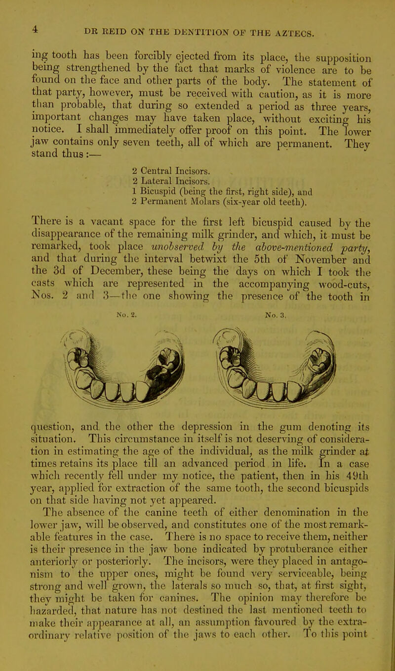 ing tooth has been forcibly ejected from its place, the supposition being strengthened by the fact that marks of violence are to be found on the face and other parts of the body. The statement of that party, however, must be received with caution, as it is more than probable, that during so extended a period as three years, important changes may have taken place, without exciting his notice. I shall immediately offer proof on this point. The lower jaw contains only seven teeth, all of which are permanent. They stand thus:— 2 Central Incisors. 2 Lateral Incisors. 1 Bicuspid (being the first, right side), and 2 Permanent Molars (six-year old teeth). There is a vacant space for the first left bicuspid caused by the disappearance of the remaining milk grinder, and which, it must be remarked, took place unobserved by the above-mentioned party, and that during the interval betwixt the 5th of November and the 3d of December, these being the days on which I took tlie casts which are represented in the accompanying wood-cuts, Nos. 2 and 3—the one showing the presence of the tooth in No. 2. No. 3. question, and the other the depression in the gum denoting its situation. This circumstance in itself is not deserving of considera- tion in estimating the age of the individual, as the milk grinder ai times retains its place till an advanced period in life. In a case which recently fell under my notice, the patient, then in his 49th year, applied for extraction of the same tooth, the second bicuspids on that side having not yet appeared. The absence of the canine teetli of either denomination in tlie lower jaw, will be observed, and constitutes one of the most remark- able featui'es in the case. There is no space to receive them, neither is their presence in tlie jaw bone indicated by protubei'ance either anteriorly or posteriorly. The incisors, were they placed in antago- nism to the upper ones, might be found very serviceable, being strong and well grown, the laterals so much so, that, at first sight, thev might be taken for canines. The opinion may thcx'efore be hazarded, that nature has not destined the last mentioned teeth to make their appearance at all, an assumption favoured by the extra- ordinary relative position of the jaws to each other. To this point