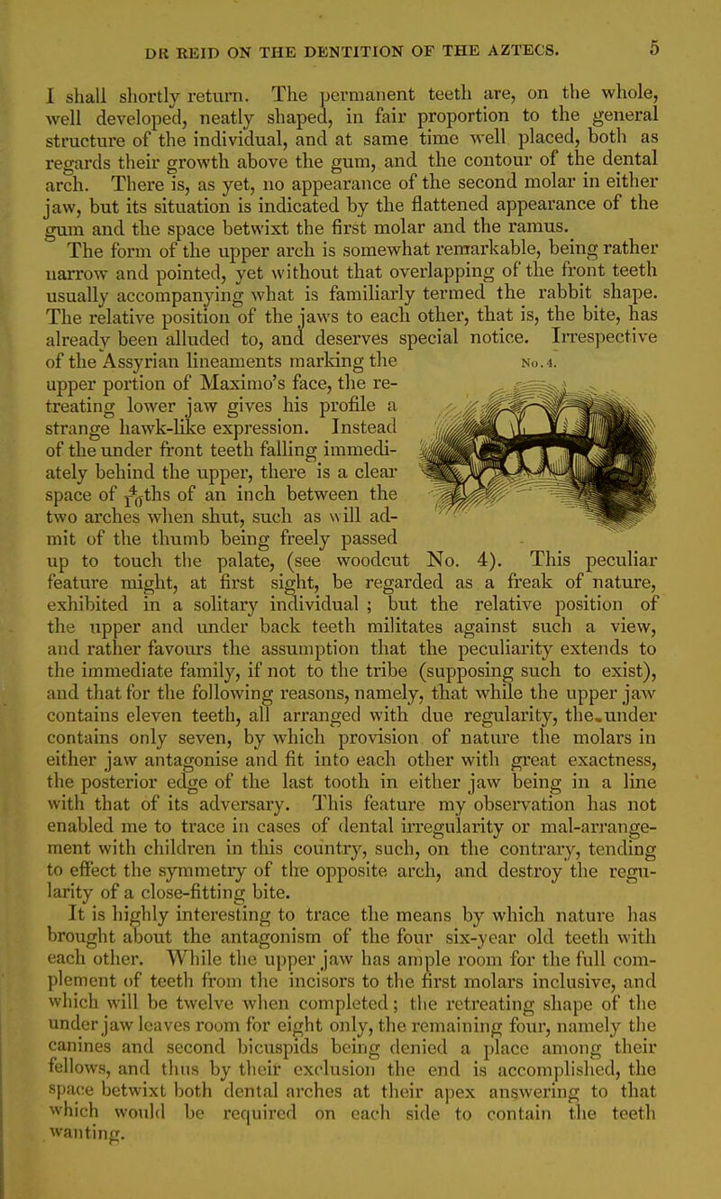 1 shall shortly return. The permanent teeth are, on the whole, well developed, neatly shaped, in fair proportion to the general structure of the individual, and at same time well placed, both as regards their growth above the gum, and the contour of the dental arch. There is, as yet, no appearance of the second molar in either jaw, but its situation is indicated by the flattened appearance of the gum and the space betwixt the first molar and the ramus. The form of the upper arch is somewhat remarkable, being rather narrow and pointed, yet without that overlapping of the front teeth usually accompanying what is familiarly termed the rabbit shape. The relative position of the jaws to each other, that is, the bite, has already been alluded to, and deserves special notice. Irrespective of the Assyrian lineaments marking the No.4. upper portion of Maximo's face, the re- treating lower jaw gives his profile a strange hawk-like expression. Instead of the under front teeth falling immedi- ately behind the upper, there is a clear space of ]*o-ths of an inch between the two arches when shut, such as w ill ad- mit of the thumb being freely passed up to touch tlie palate, (see woodcut No. 4). This peculiar feature might, at first sight, be regarded as a freak of nature, exhibited in a solitary individual ; but the relative position of the upper and under back teeth militates against such a view, and rather favours the assumption that the peculiarity extends to the immediate family, if not to the tribe (supposing such to exist), and that for the following reasons, namely, that while the upper jaw contains eleven teeth, all arranged with due regularity, the,under contains only seven, by which provision of nature the molars in either jaw antagonise and fit into each other with great exactness, the posterior edge of the last tooth in either jaw being in a line with that of its adversary. This feature my observation has not enabled me to trace in cases of dental irregularity or mal-arrange- nient with children in this country, such, on the contrary, tending to effect the symmetry of tire opposite arch, and destroy the regu- larity of a close-fitting bite. It is highly interesting to trace the means by which nature has brought about the antagonism of the four six-year old teeth with each other. While the upper jaw has ample room for the full com- plement of teeth from the incisors to the first molars inclusive, and which will be twelve when completed; the retreating shape of the under jaw leaves room for eight only, the remaining four, namely the canines and second bicuspids being denied a place among their fellows, and thus by their exclusion the end is accomplished, the space betwixt both dental arches at their apex answering to that which would be required on each side to contain tlie teeth wanting.